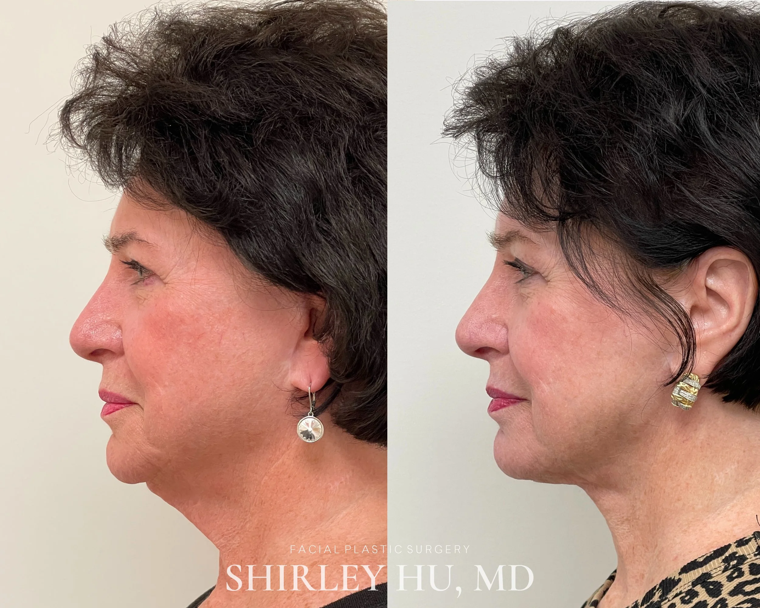 Revision extended neck lift in a 77-year-old woman