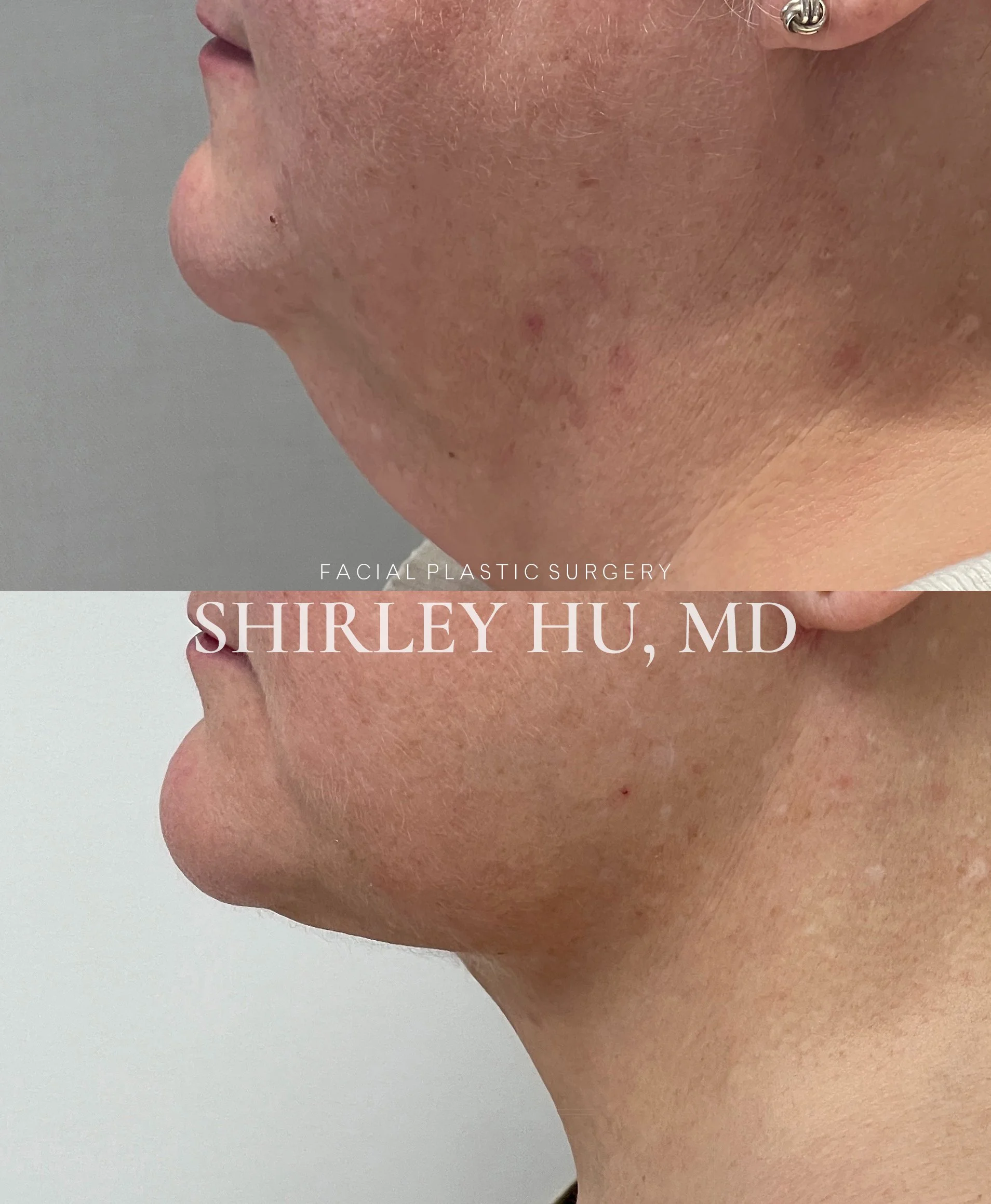 Extended deep plane face and neck lift in a 58-year-old woman