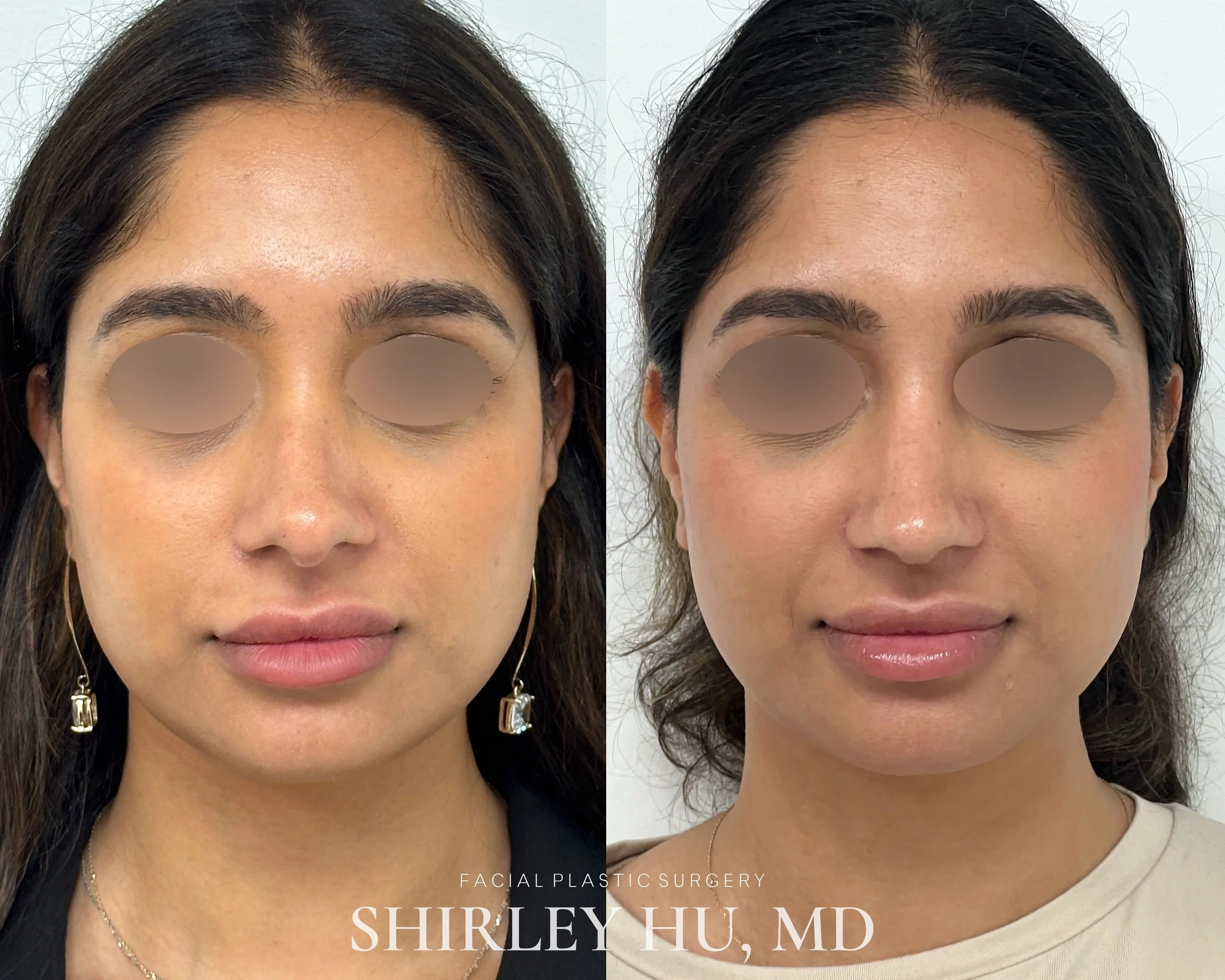 Primary rhinoplasty in a 30-year-old woman