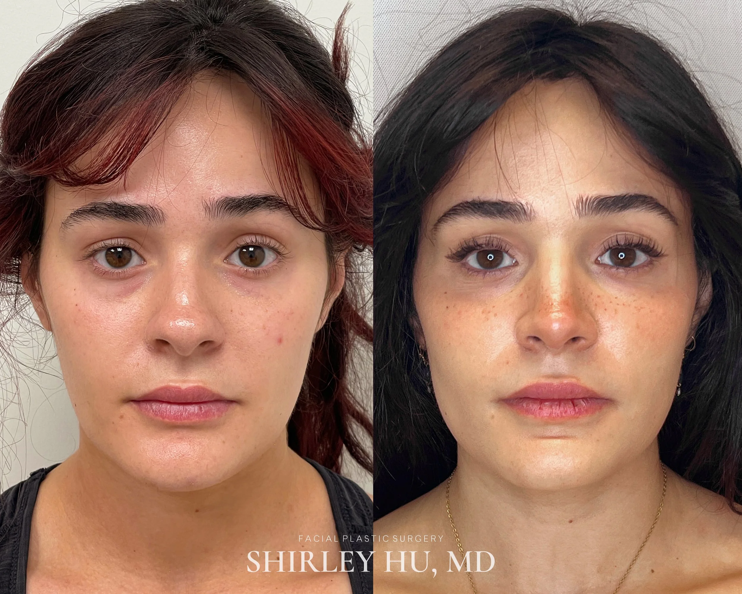 Primary rhinoplasty in a 26-year-old woman