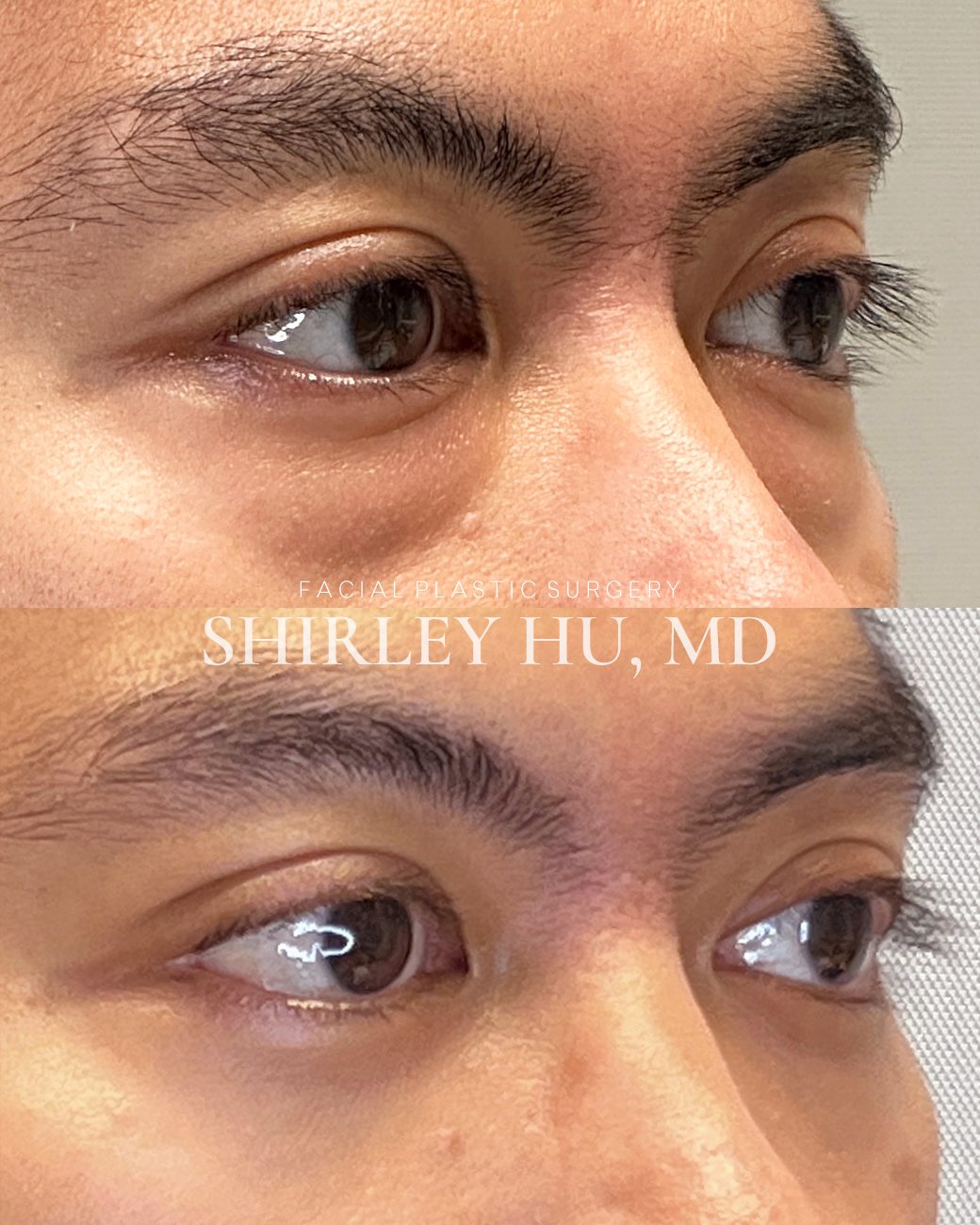 Lower blepharoplasty in a 38-year-old man