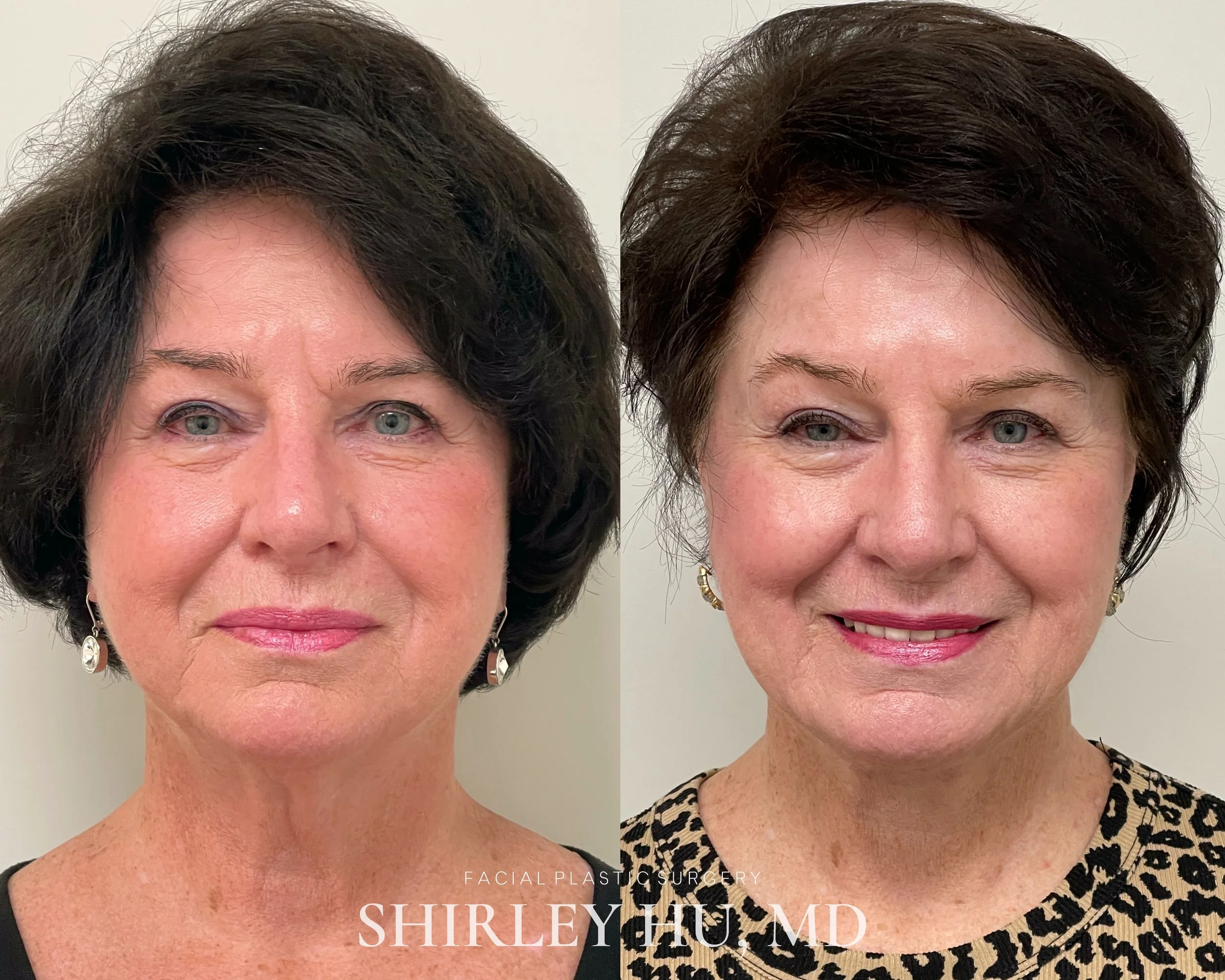 Revision extended neck lift in a 77-year-old woman