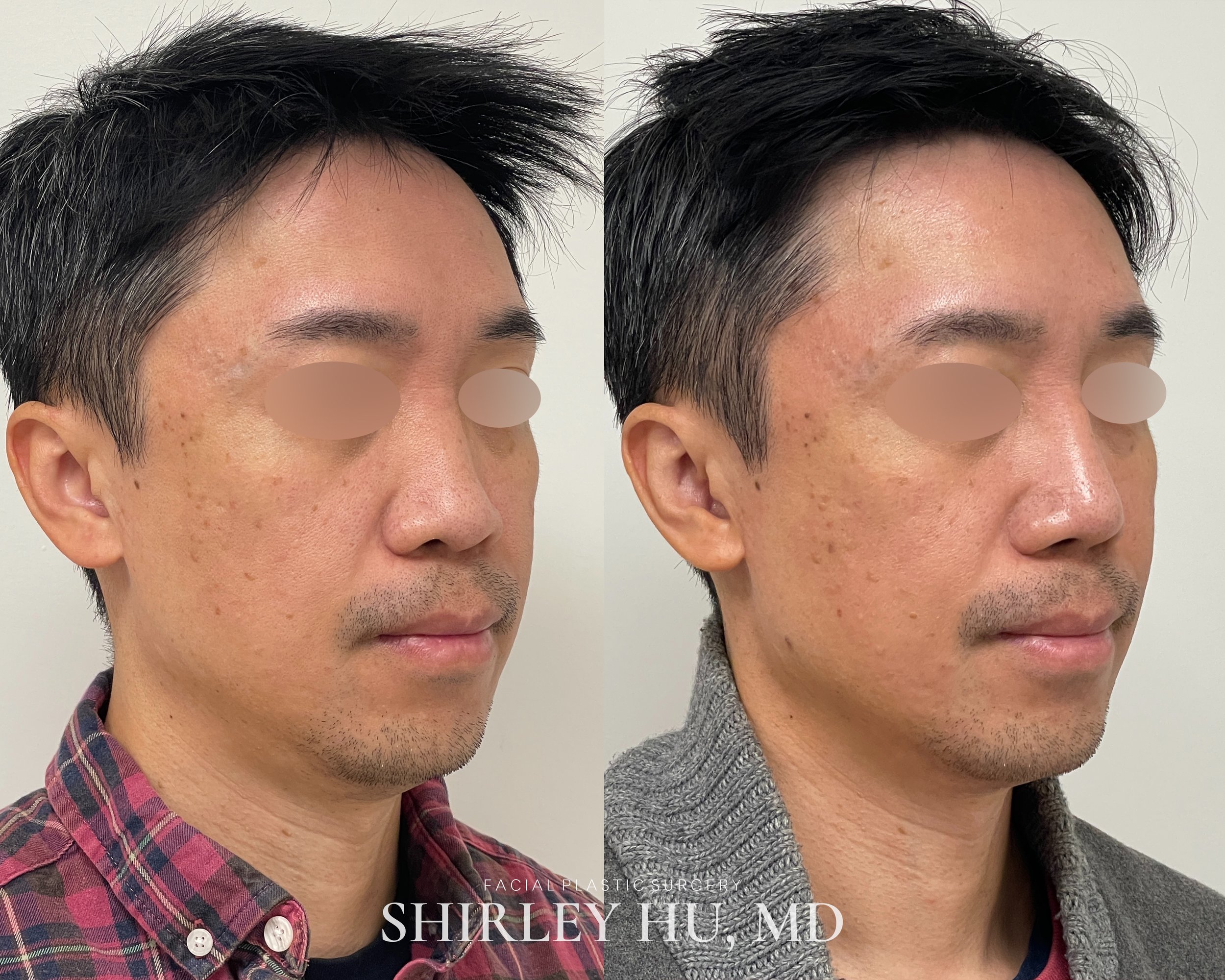 Primary rhinoplasty in a 41-year-old man