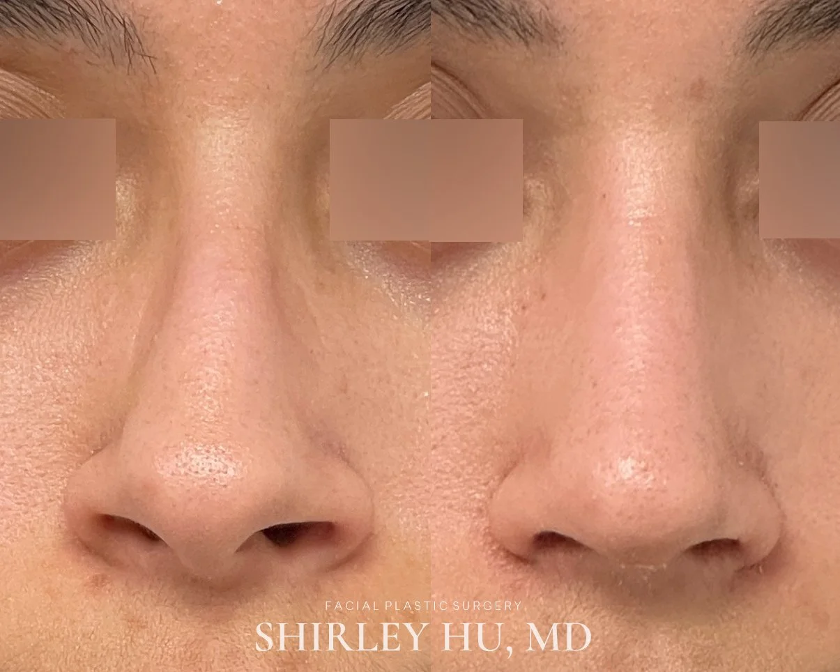 Primary rhinoplasty in a 26-year-old woman