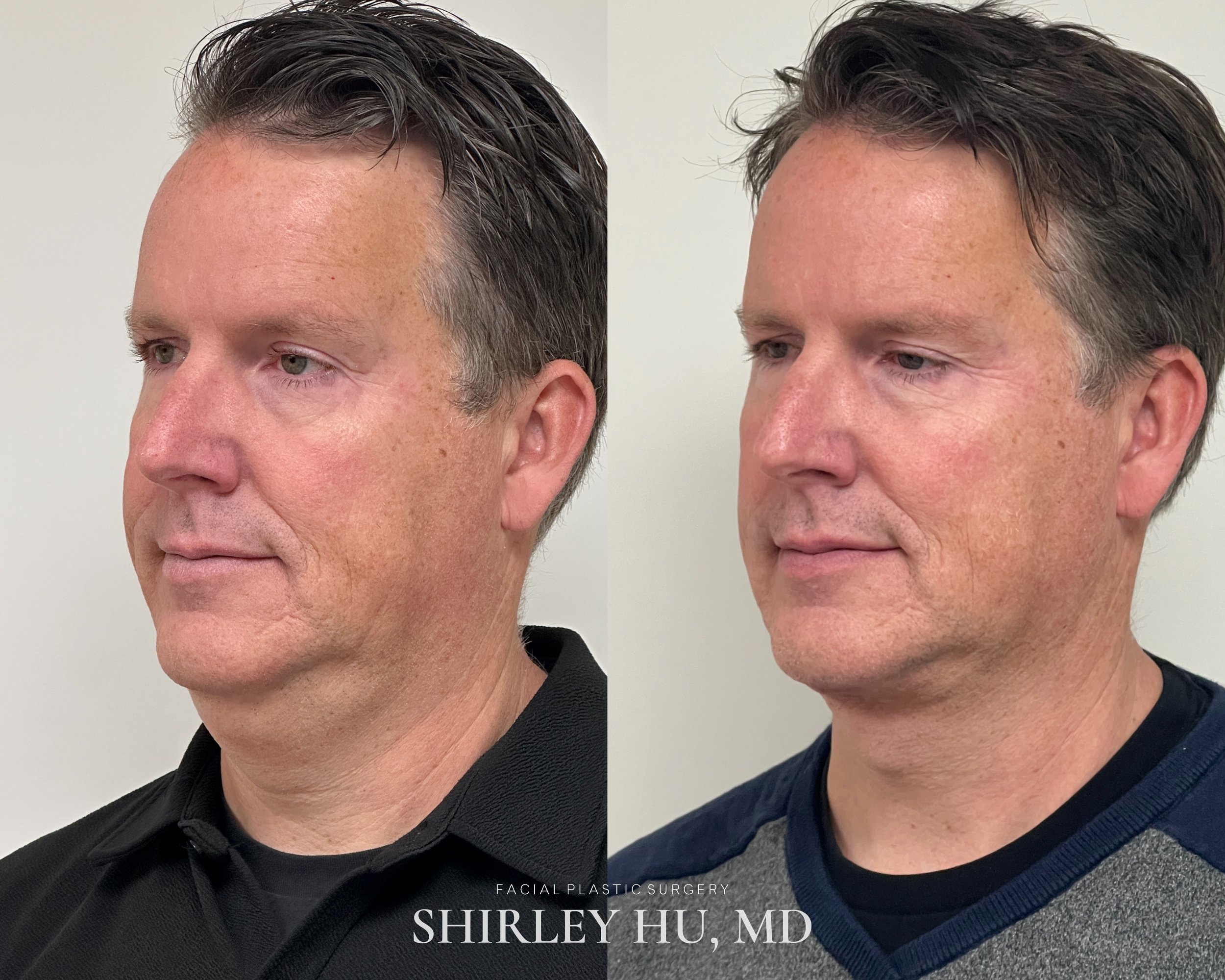 Deep neck lift, liposuction, and Renuvion neck skin tightening in a 54-year-old man