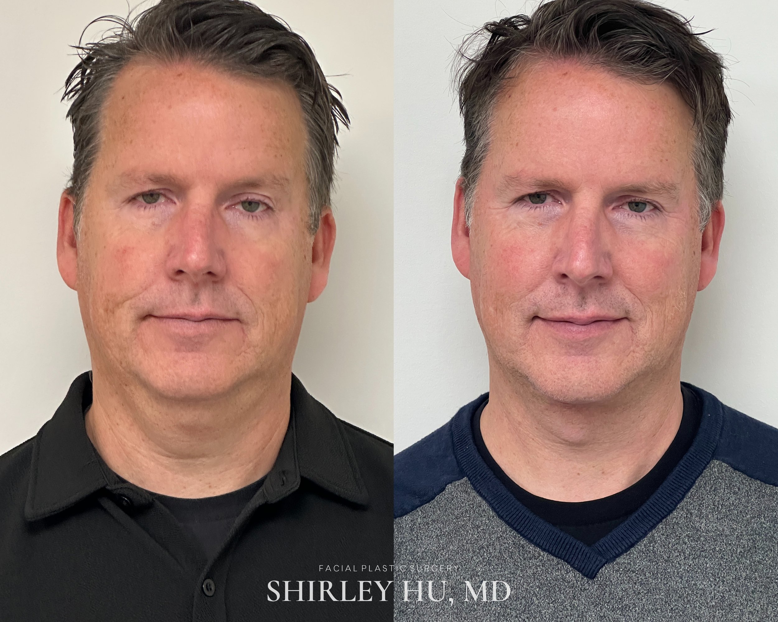 Deep neck lift, liposuction, and Renuvion neck skin tightening in a 54-year-old man