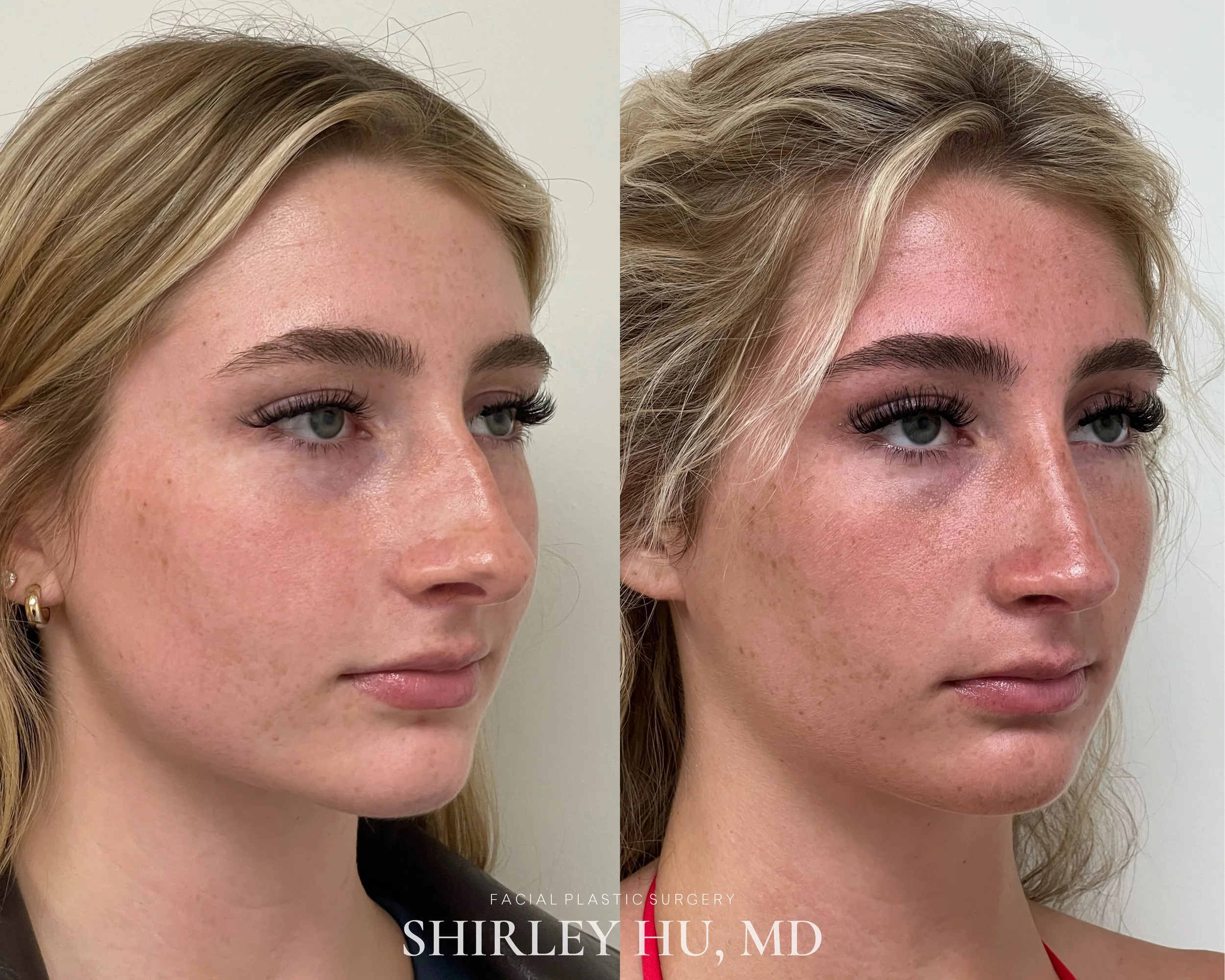 Primary rhinoplasty in a 22-year-old woman