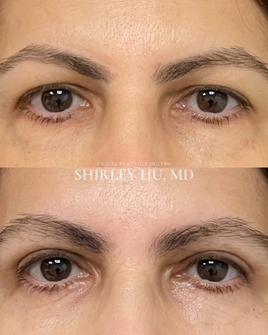 Upper and lower lid blepharoplasty in a 52-year-old woman