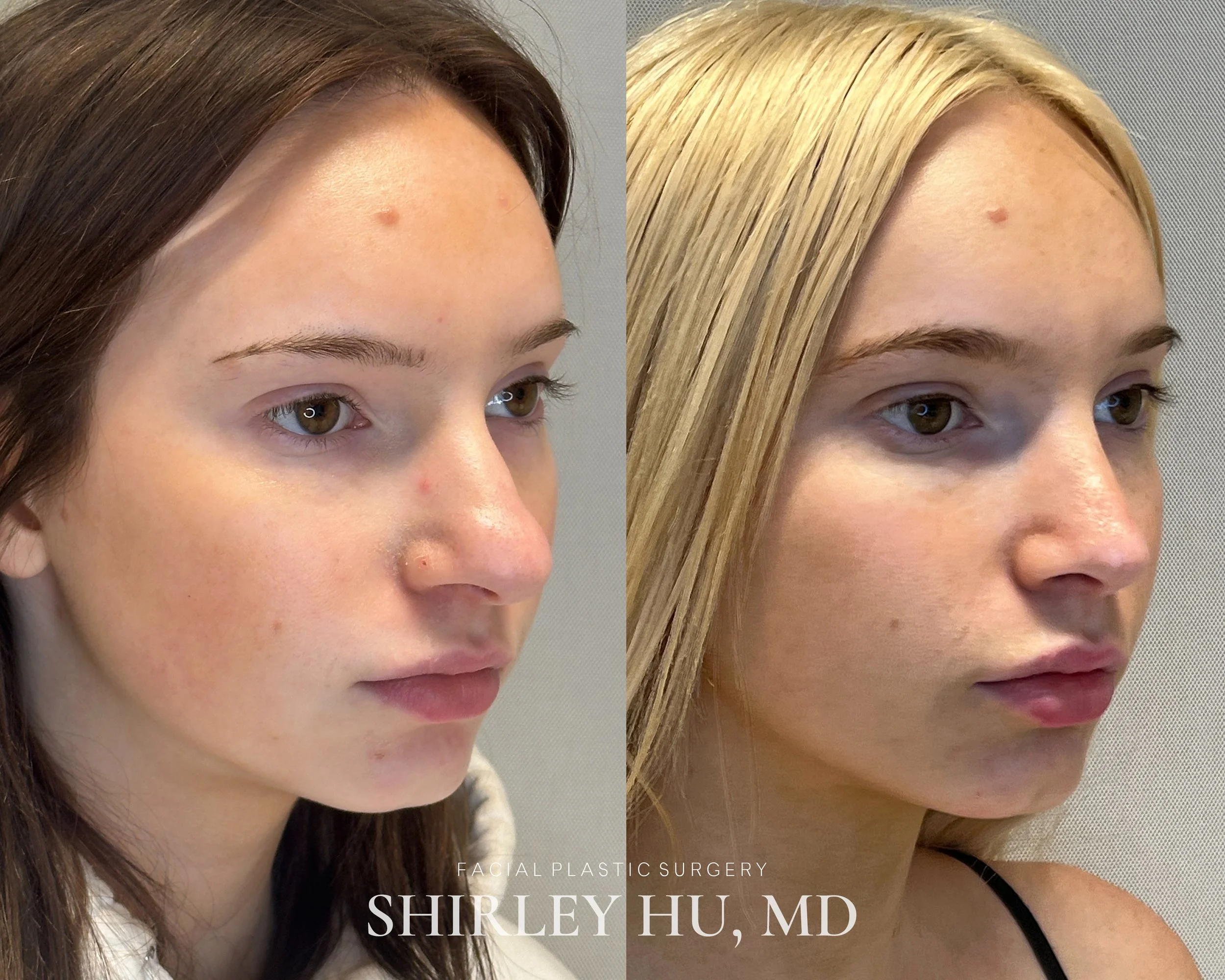 Primary rhinoplasty in an 18-year-old woman