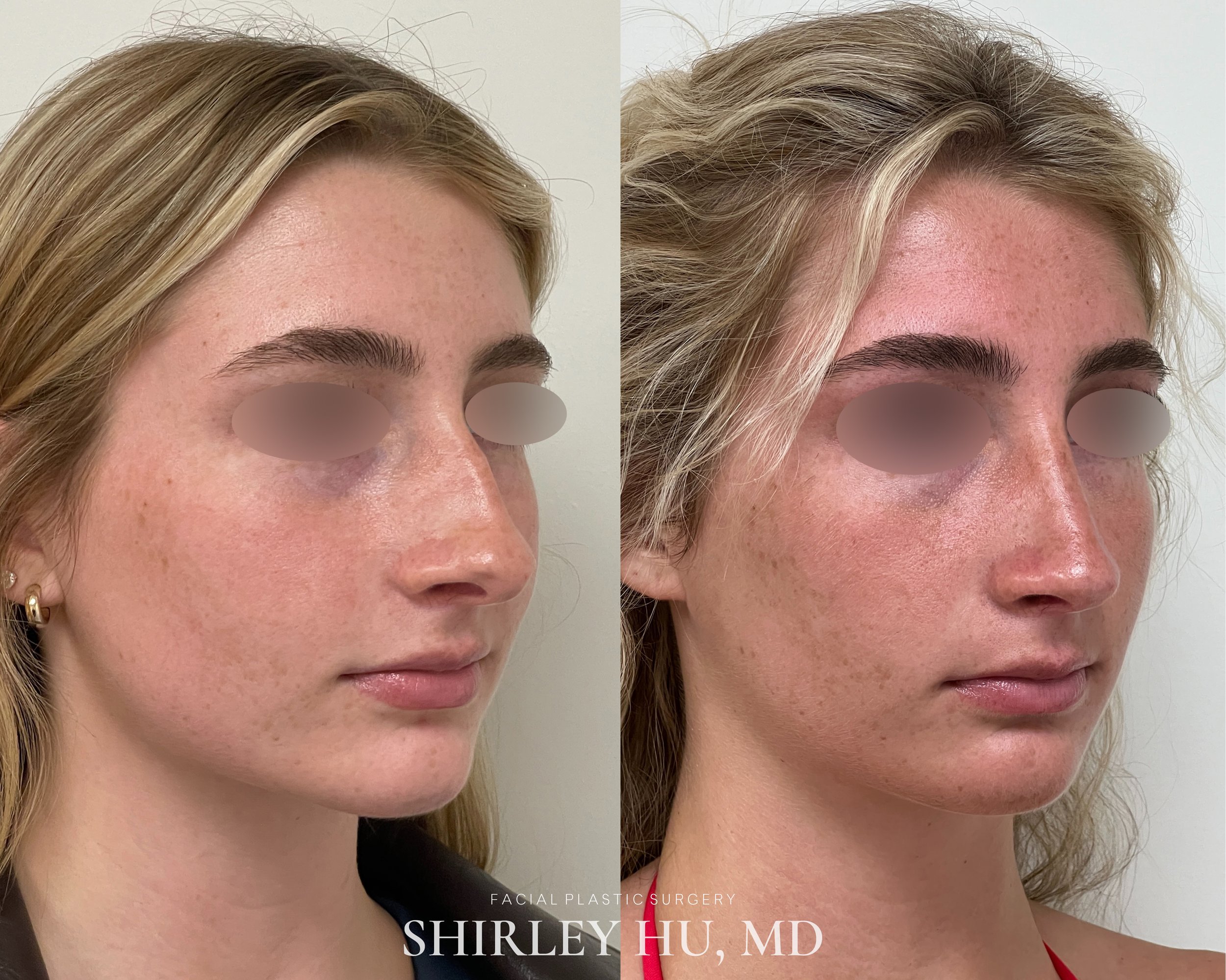 Primary rhinoplasty in a 22-year-old woman