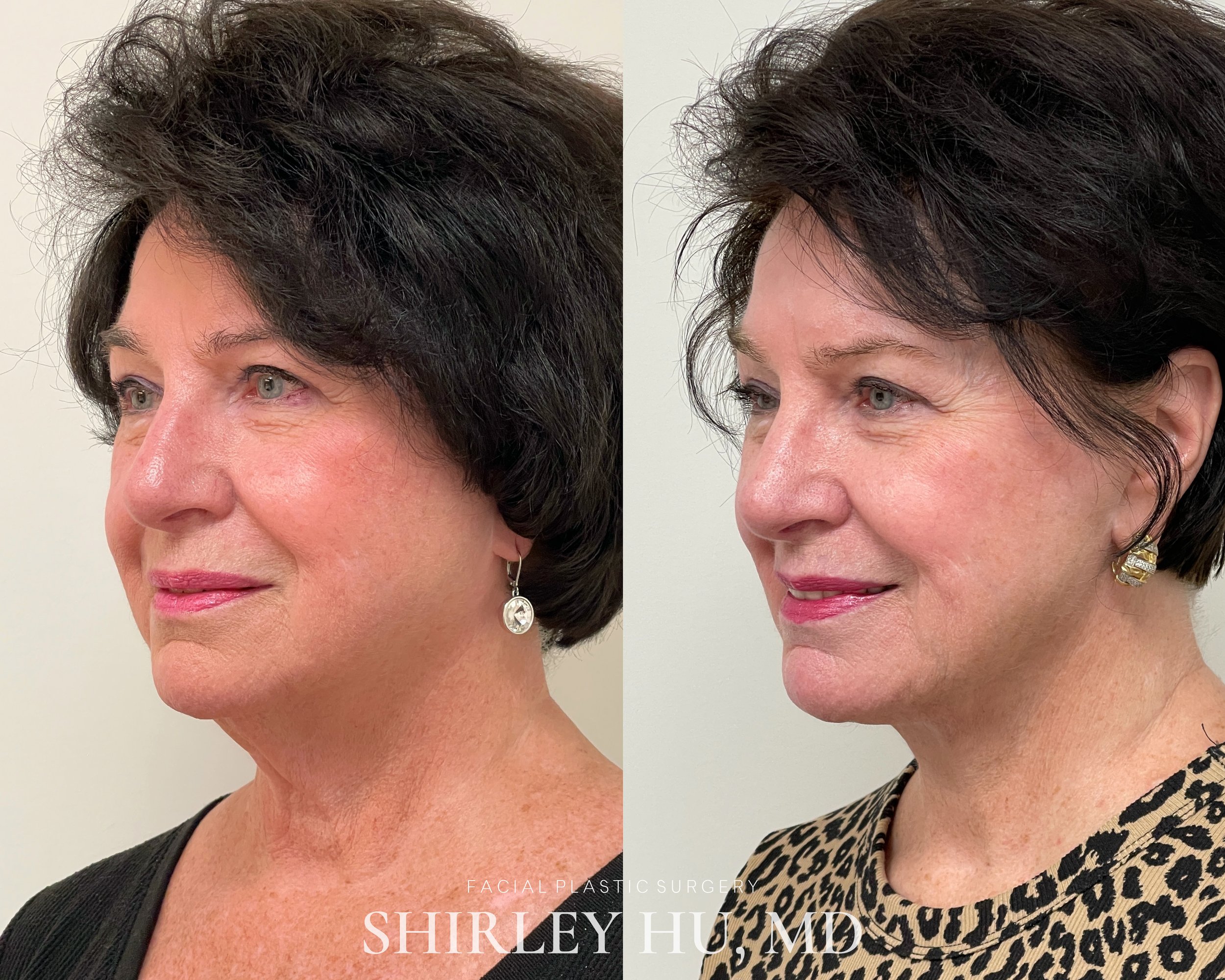 Revision extended neck lift in a 77-year-old woman