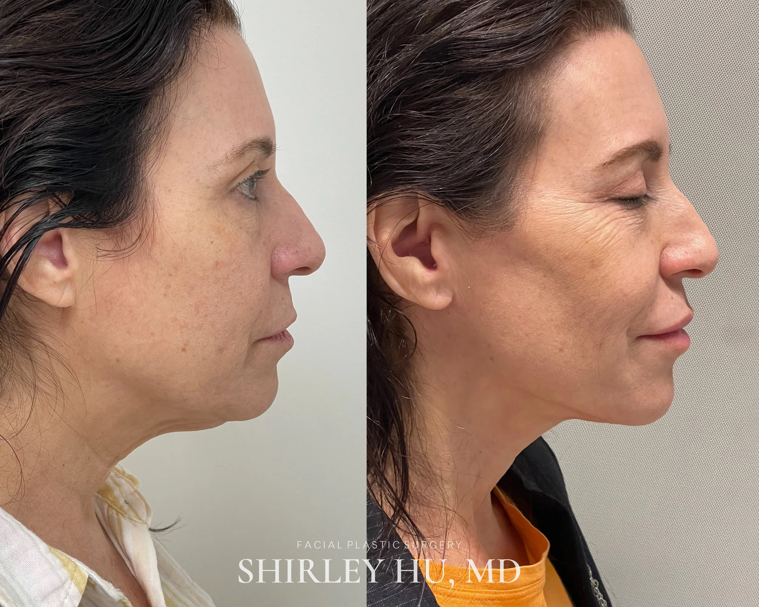 Extended neck lift in a 59-year-old woman