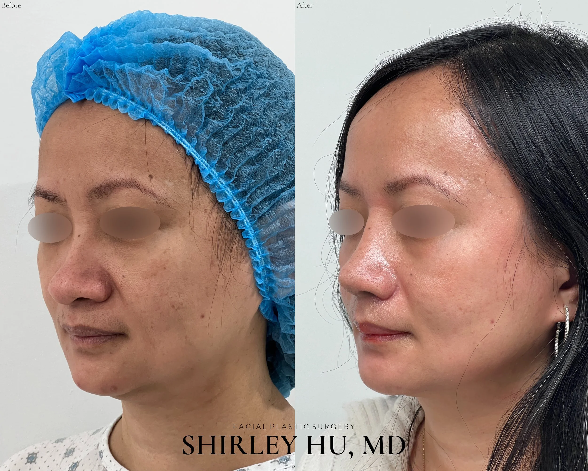 Primary rhinoplasty with rib cartilage in a 45-year-old woman