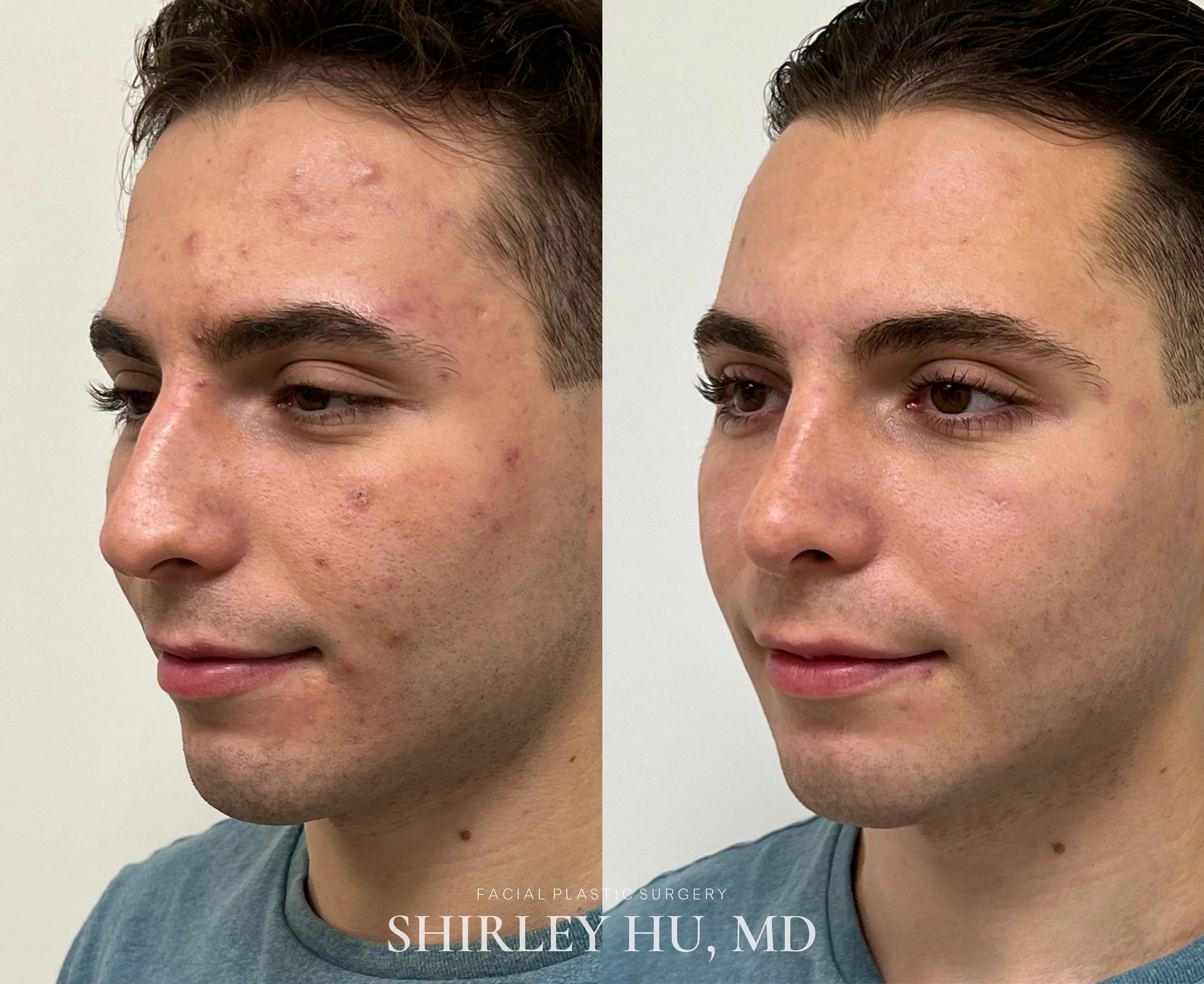 Primary rhinoplasty in a 20-year-old male