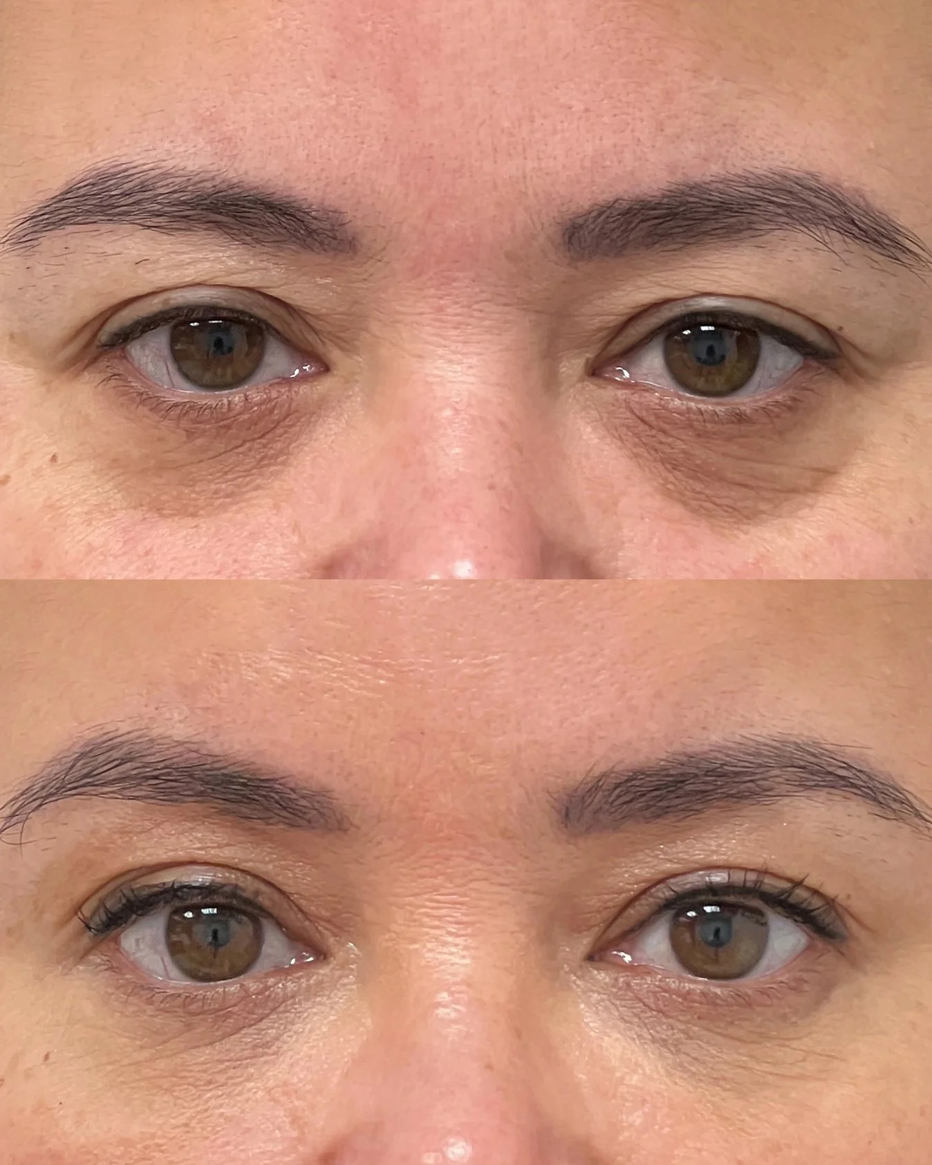 Microfat grafting to lower eyelids