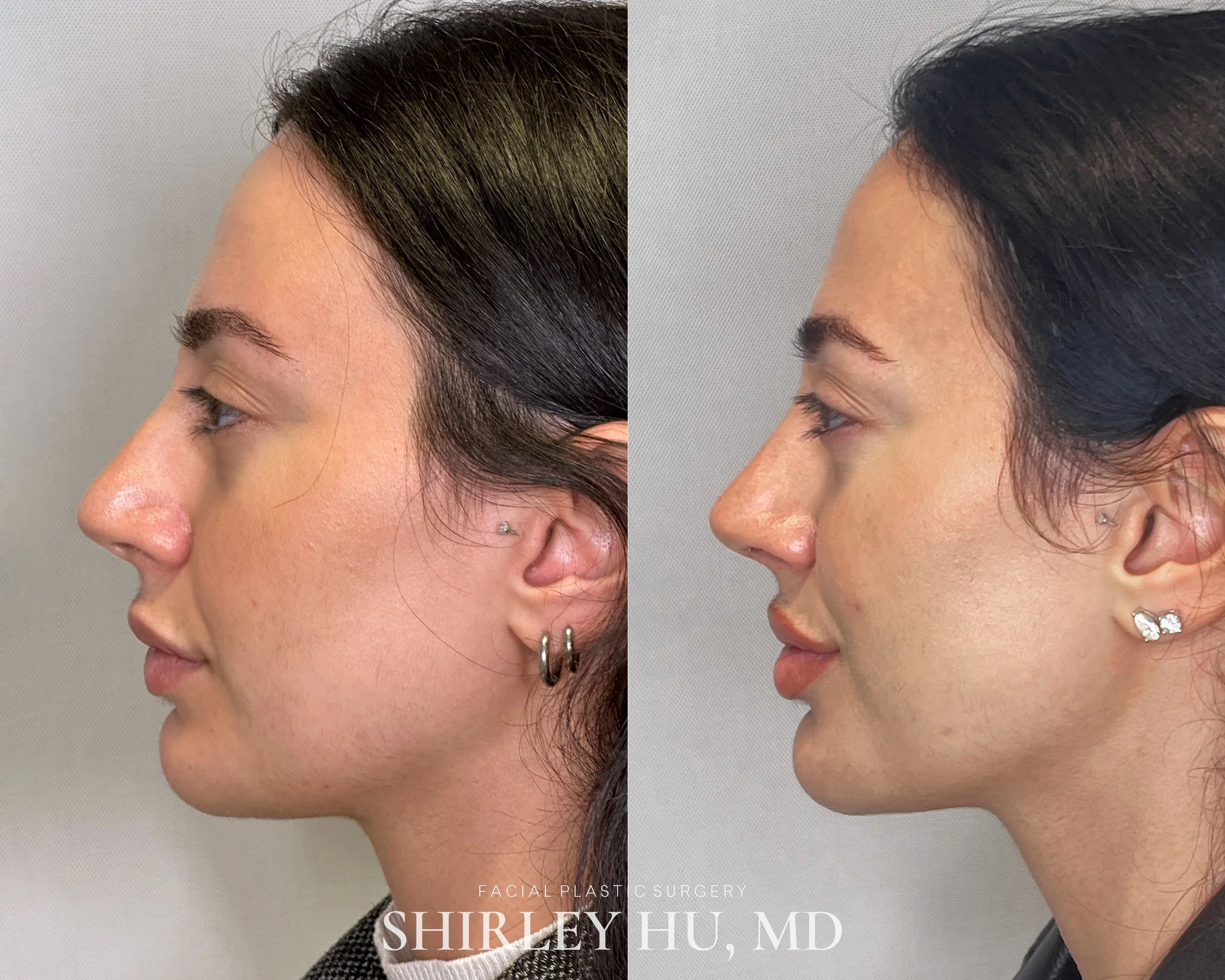Primary rhinoplasty in a 28-year-old woman