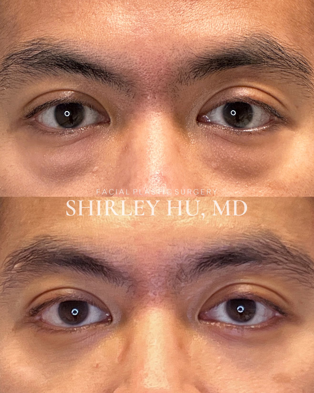 Lower blepharoplasty in a 38-year-old man