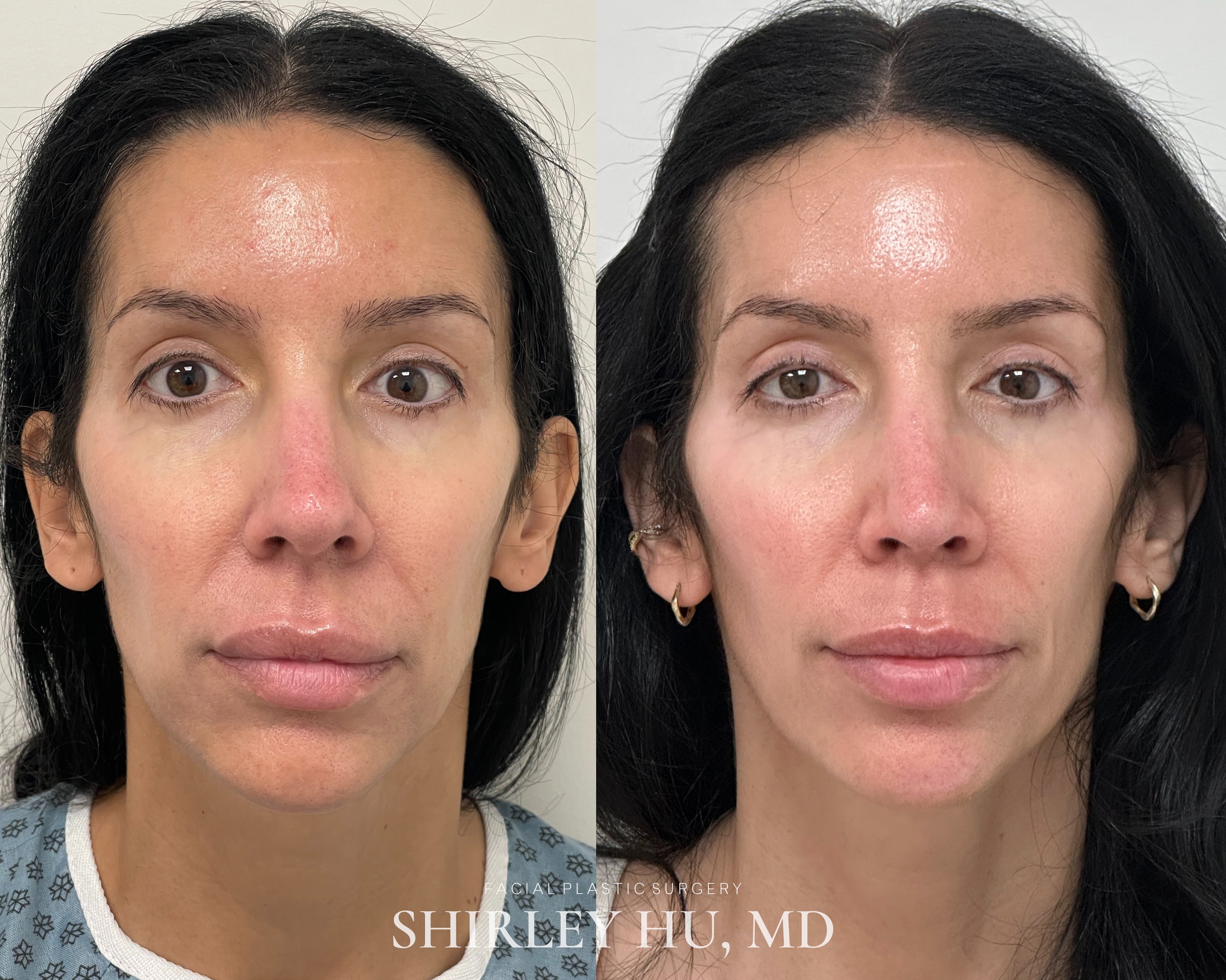 Primary rhinoplasty in a 42-year-old woman 