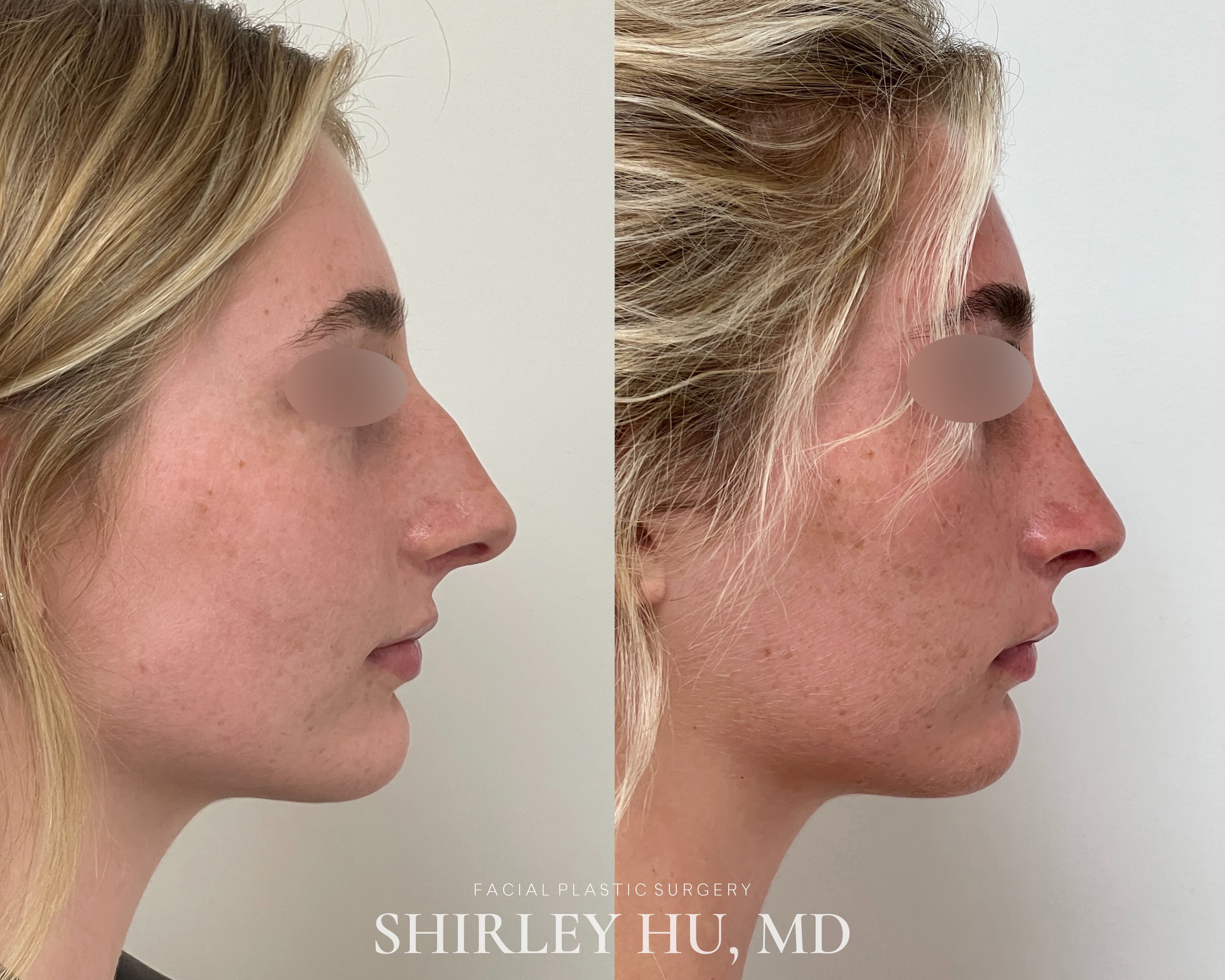 Primary rhinoplasty in a 22-year-old woman