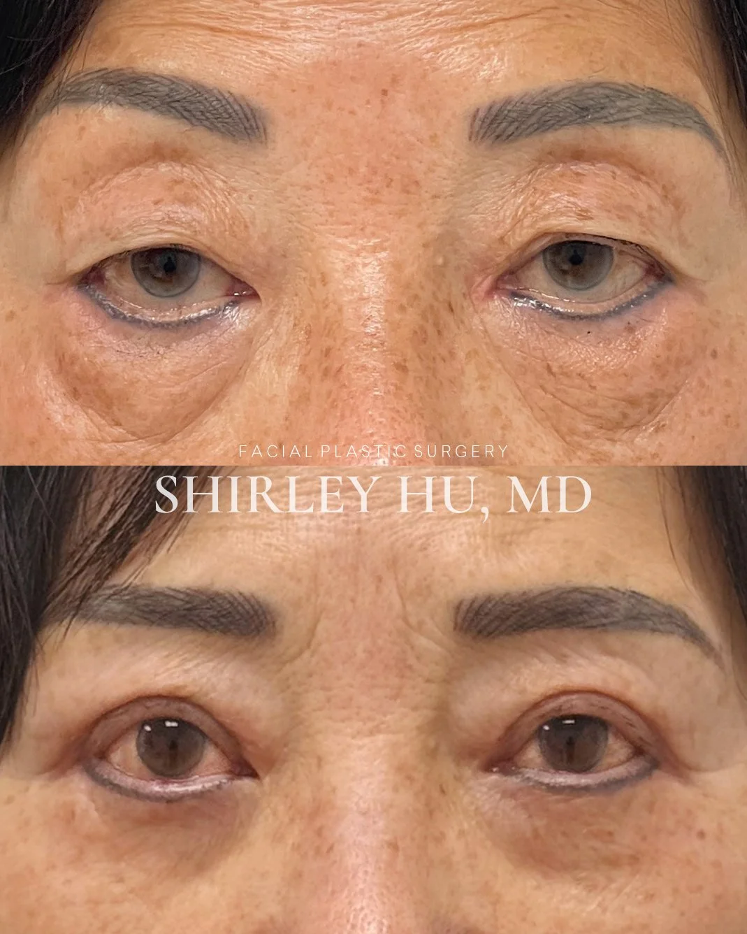 Upper blepharoplasty with crease formation and lower blepharoplasty in a 66-year-old woman