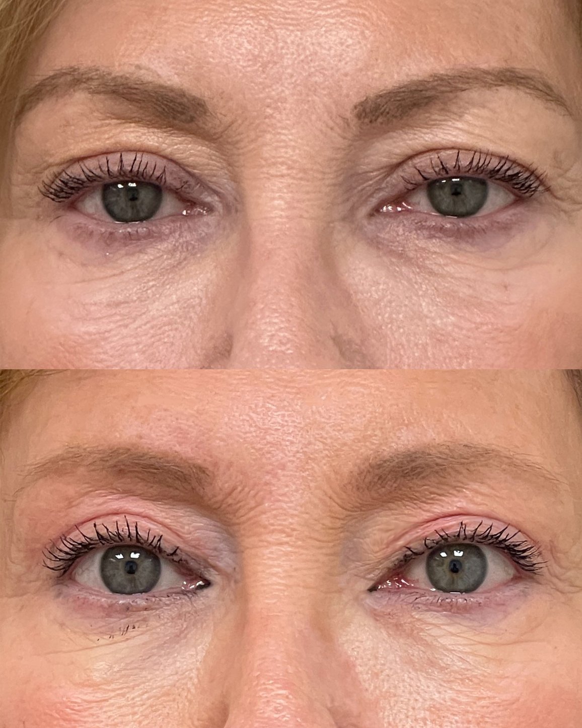 Ptosis Repair