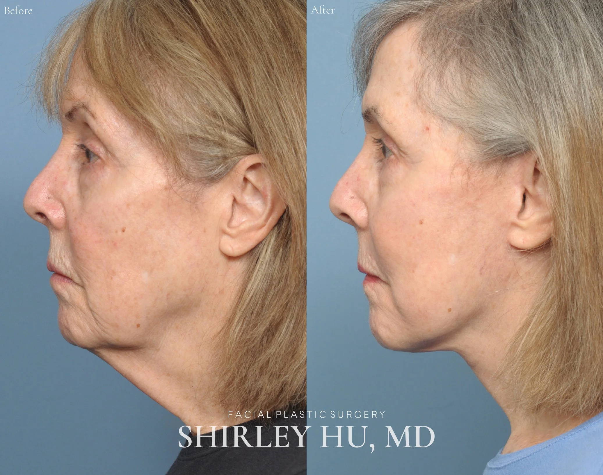 Facelift, neck lift, and perioral laser resurfacing in a 68-year-old woman