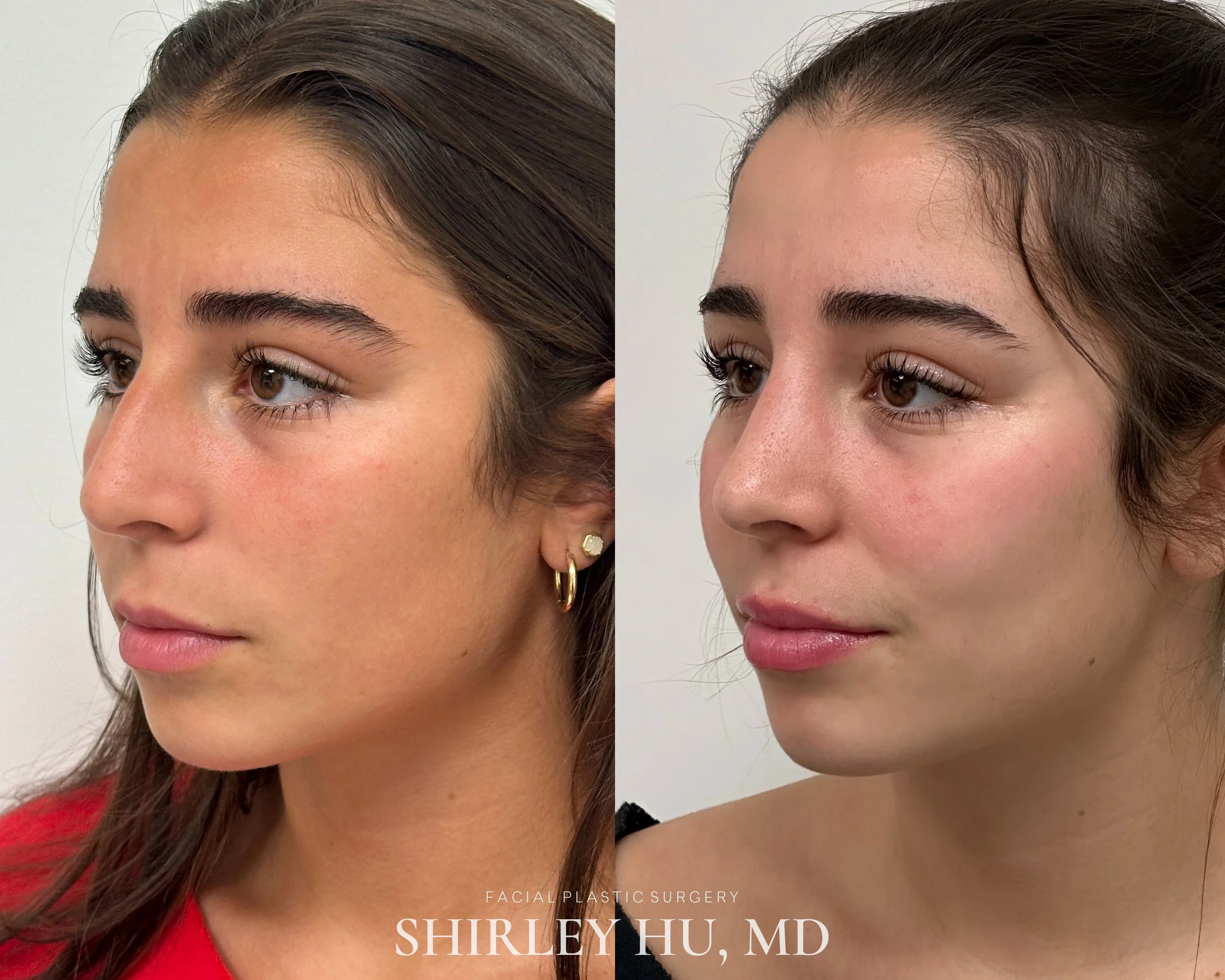 Primary rhinoplasty in a 17-year-old woman