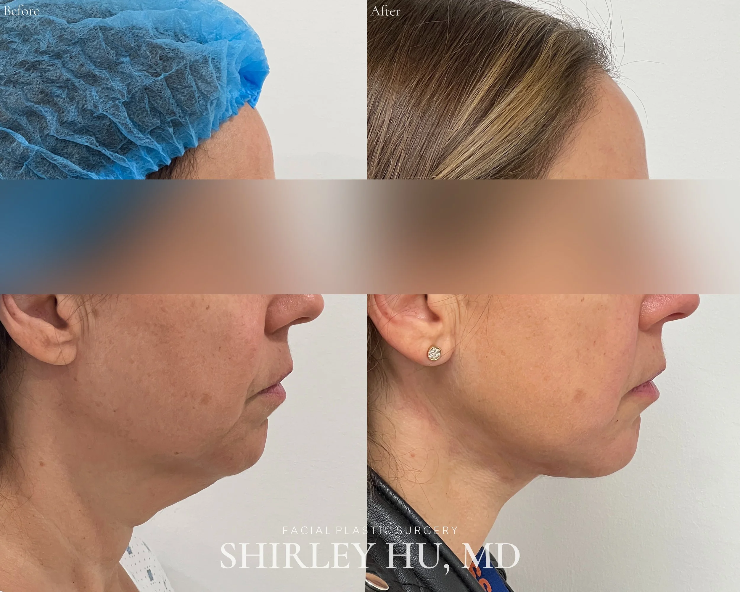 Extended neck lift in a 46-year-old woman 