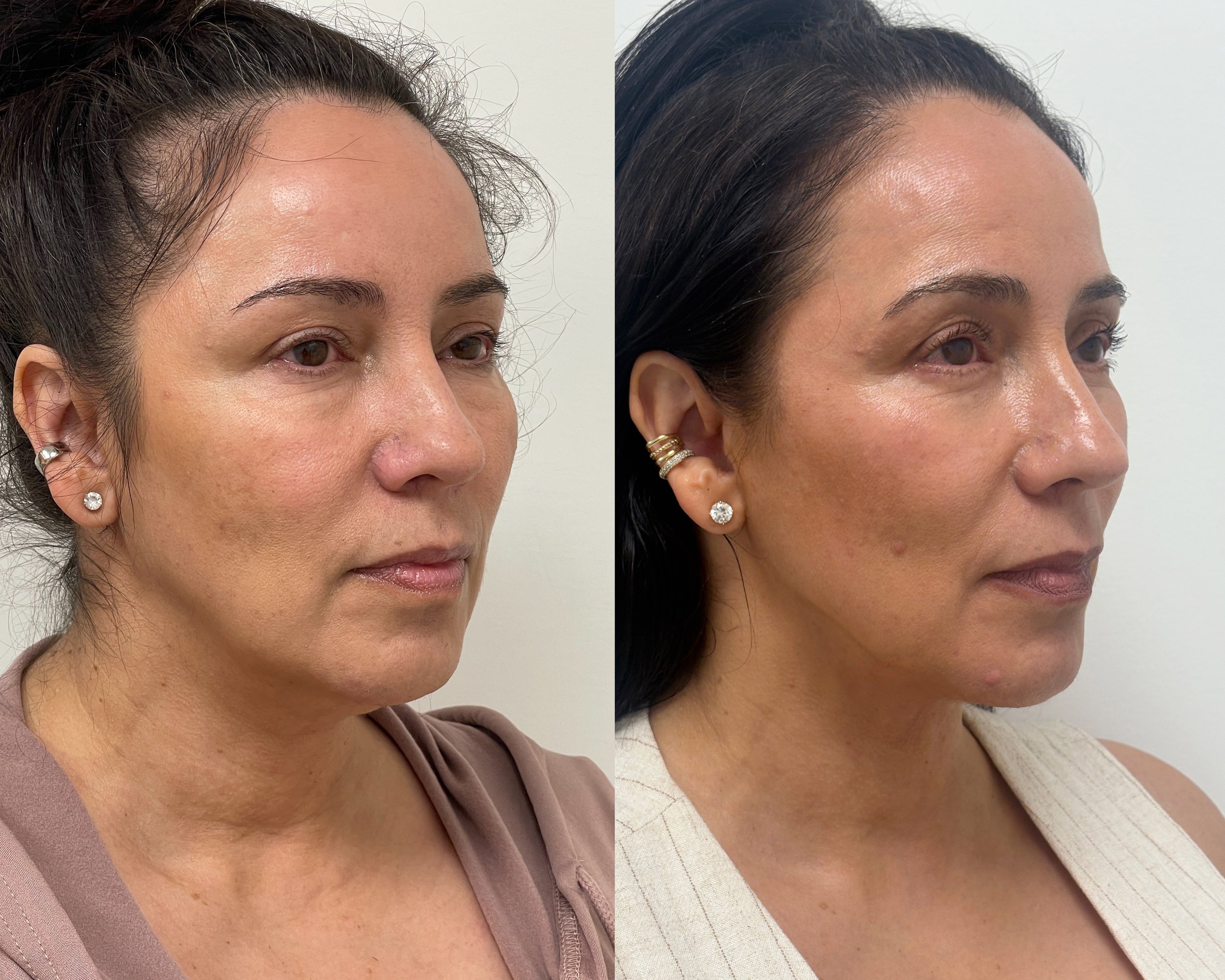 Deep neck lift, liposuction, and Renuvion skin tightening in a 54-year-old woman