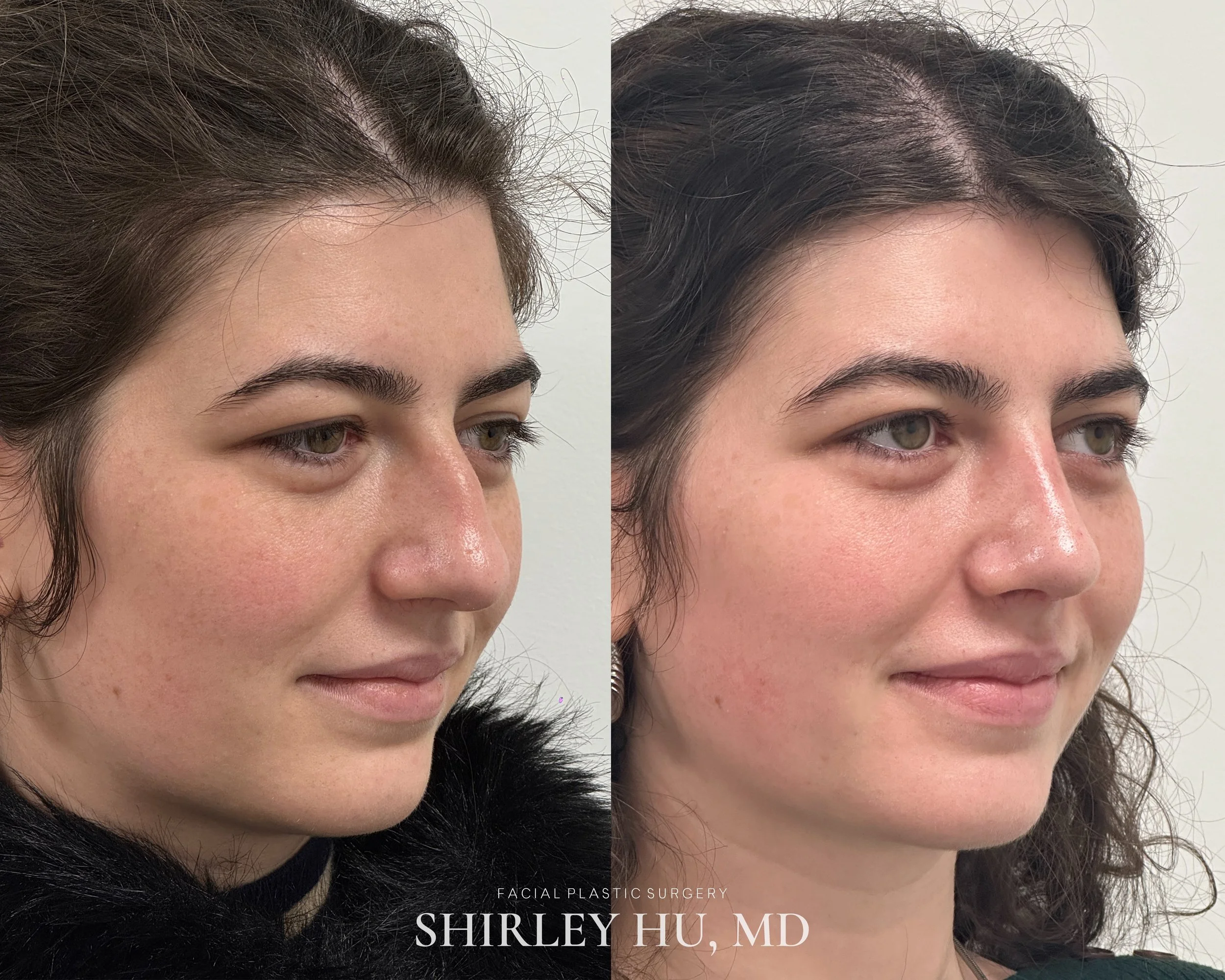 Primary rhinoplasty in a 29-year-old woman