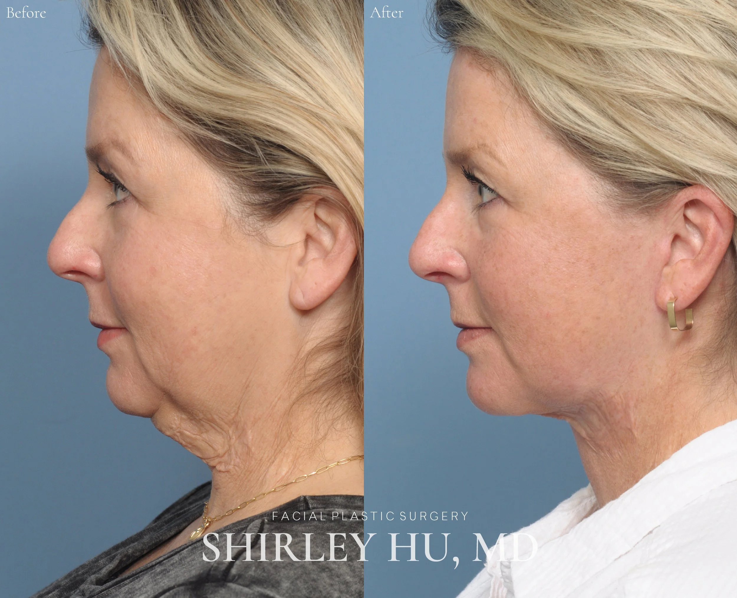 Extended deep plane face and neck lift in a 52-year-old woman