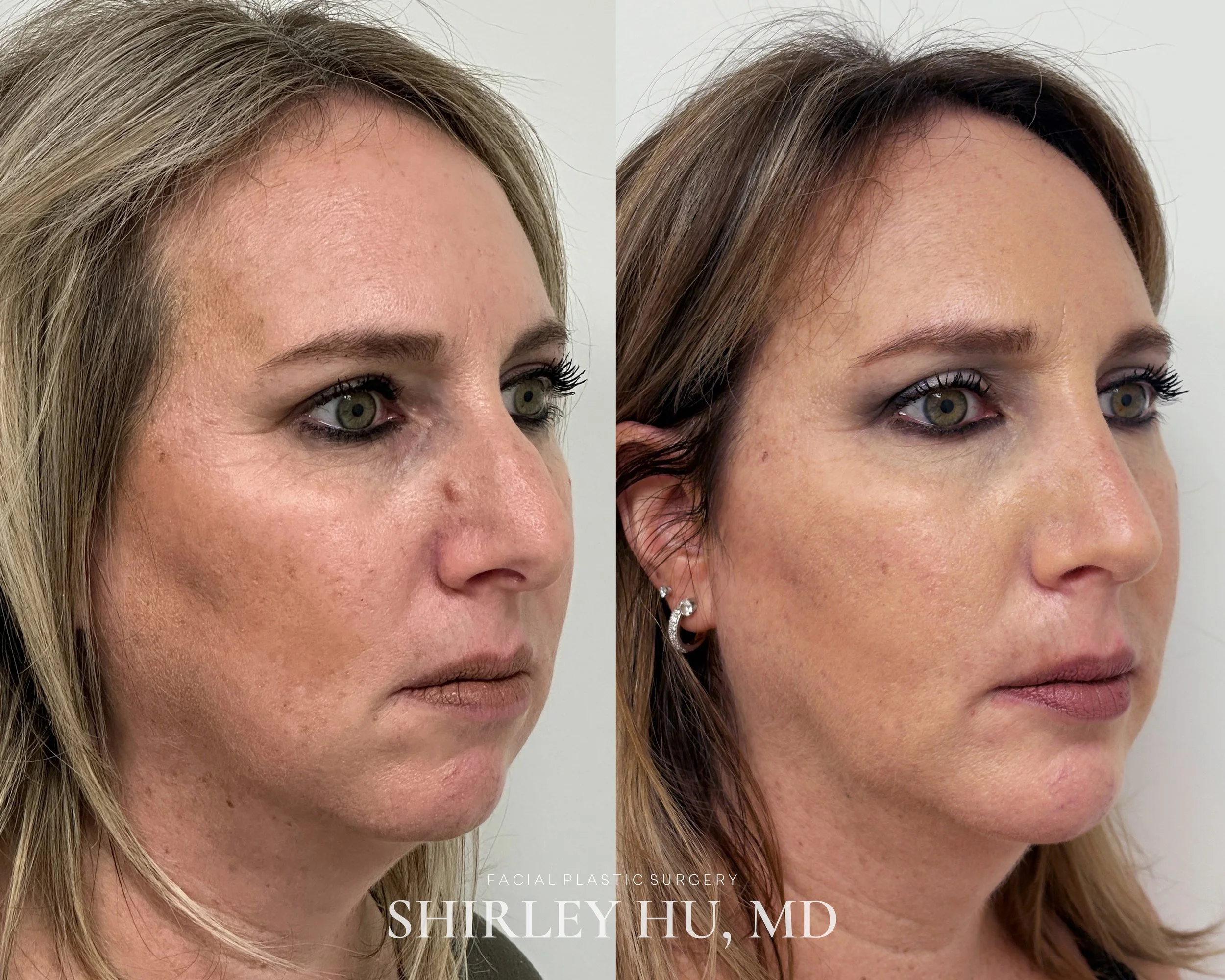 Rhinoplasty and chin implant in a 49-year-old woman
