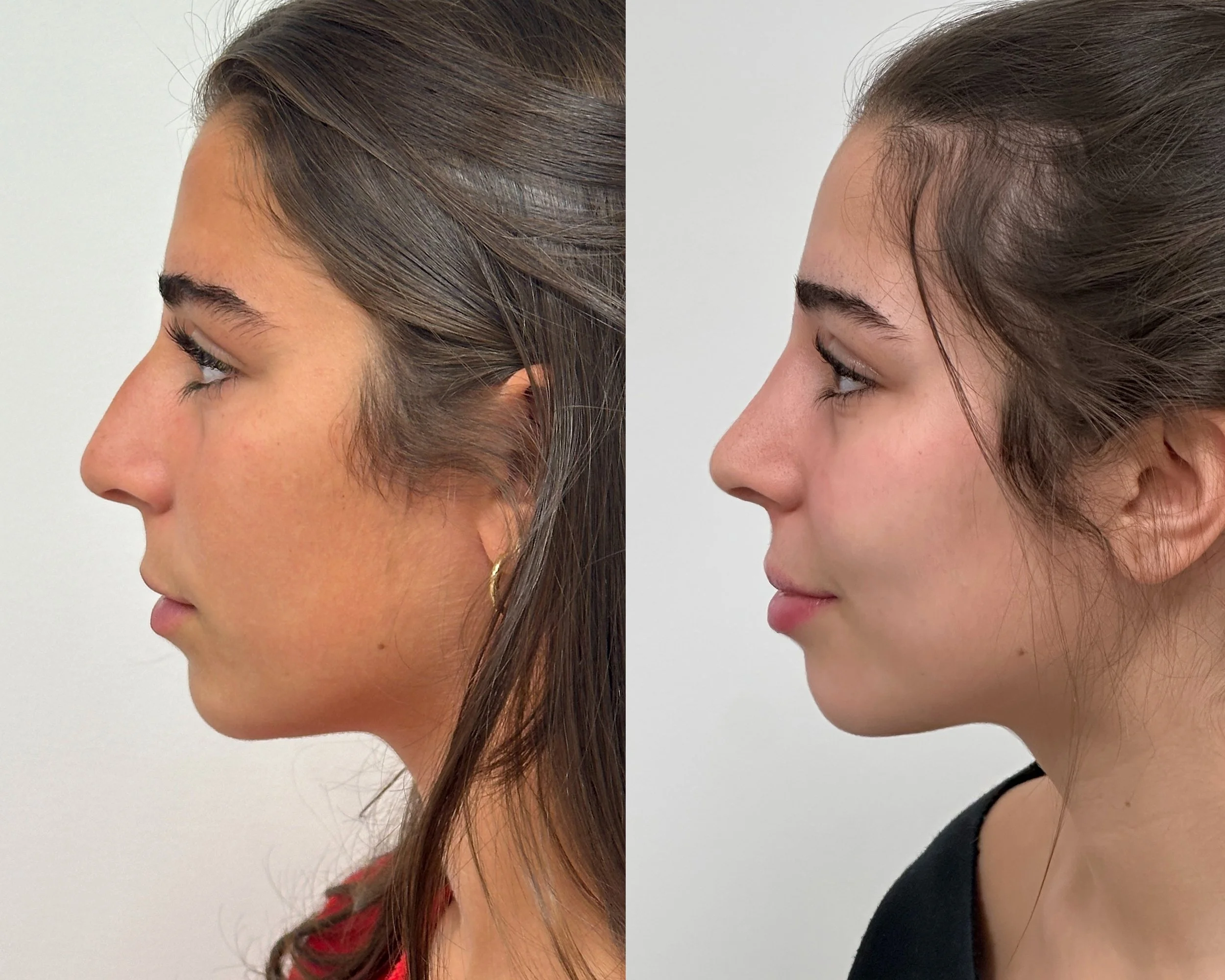 Primary rhinoplasty in a 17-year-old woman