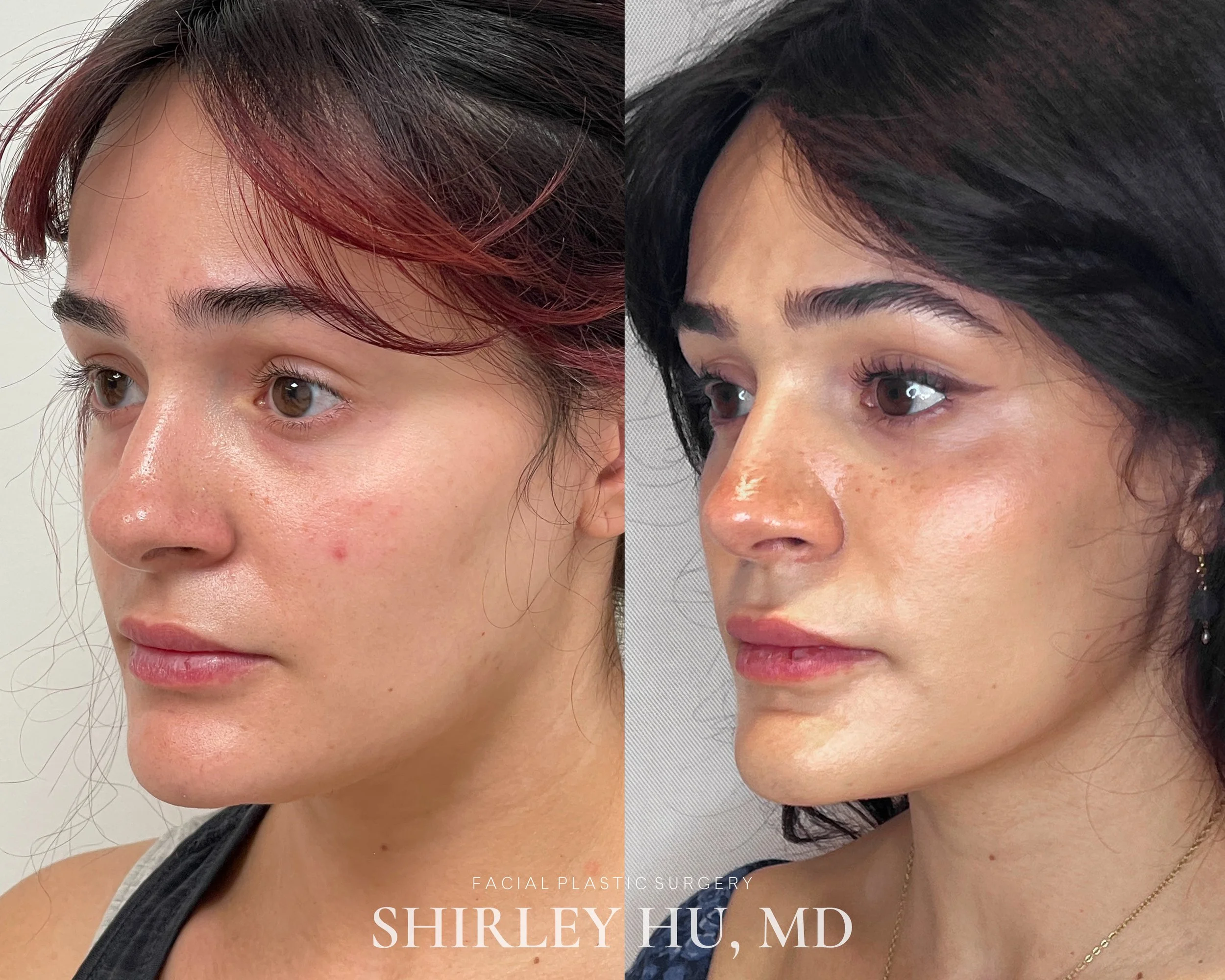 Primary rhinoplasty in a 26-year-old woman