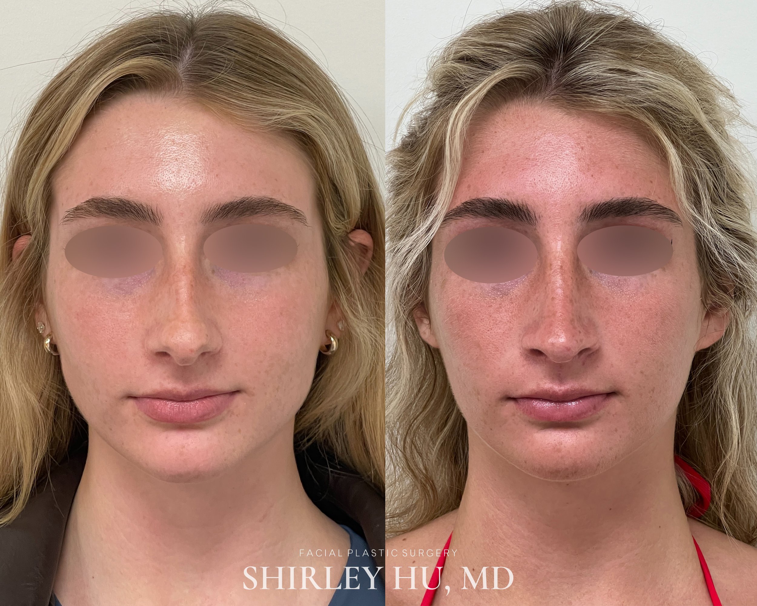 Primary rhinoplasty in a 22-year-old woman