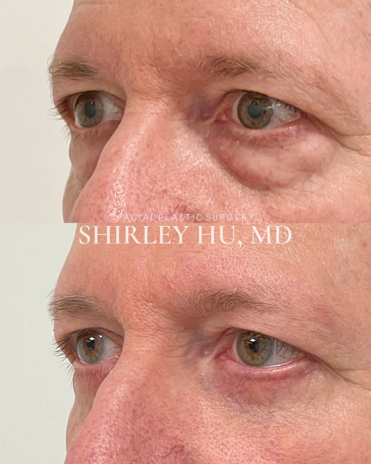 Lower blepharoplasty in a 63-year-old man