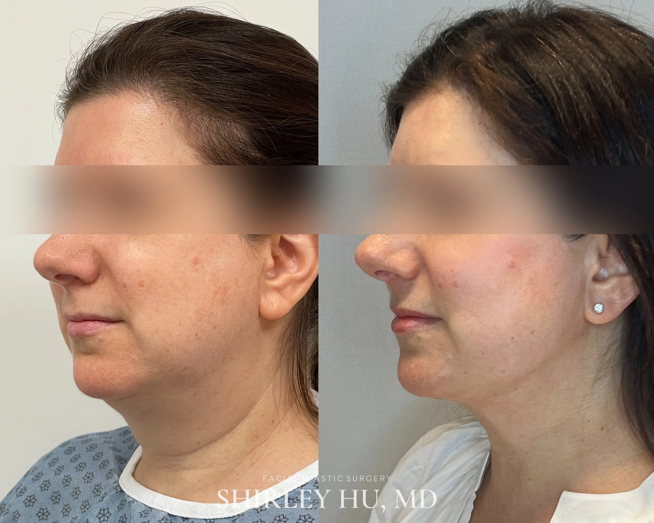 Deep neck lift, liposuction, and Renuvion skin tightening in a 52-year-old woman
