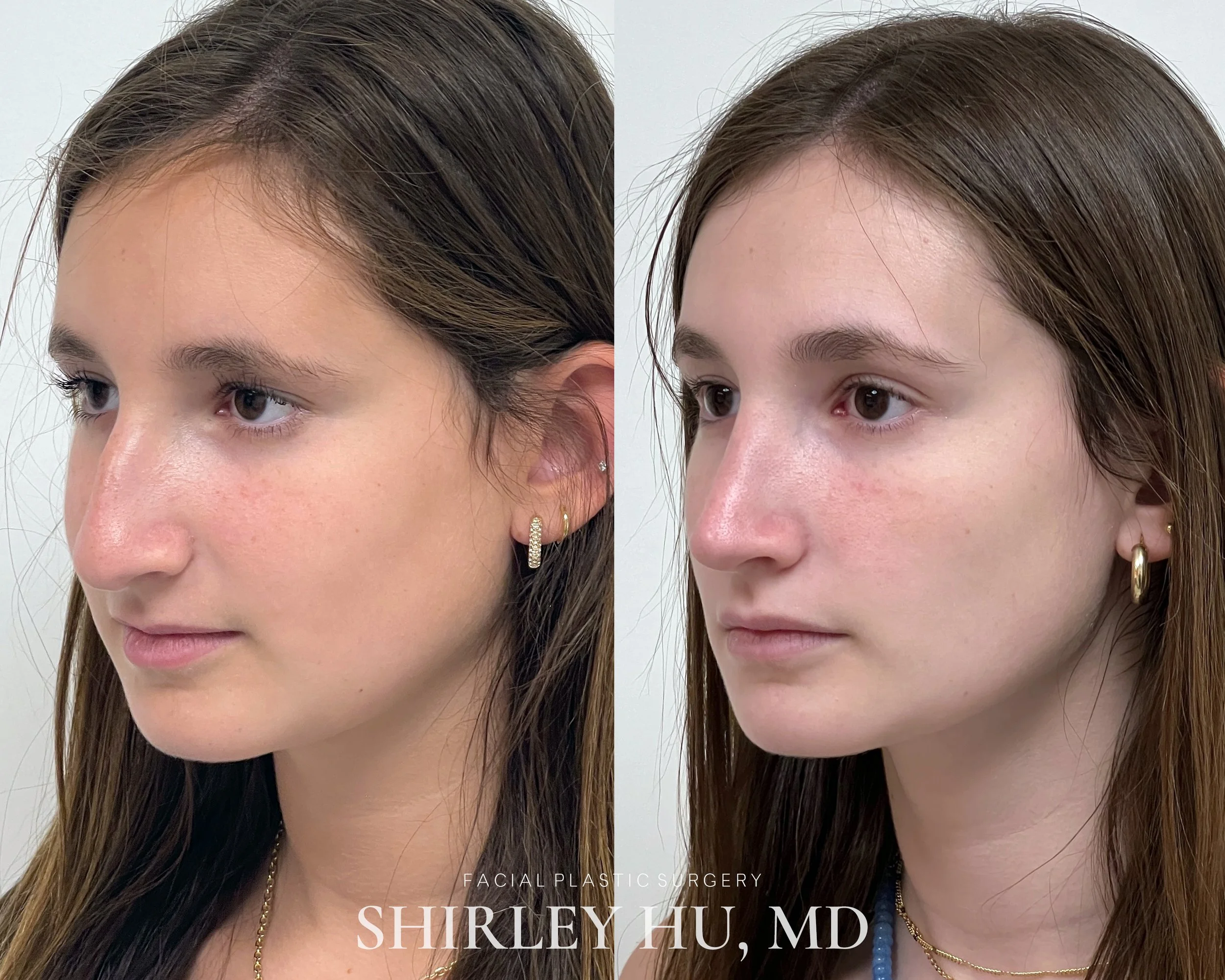 Primary rhinoplasty in a 15-year-old female