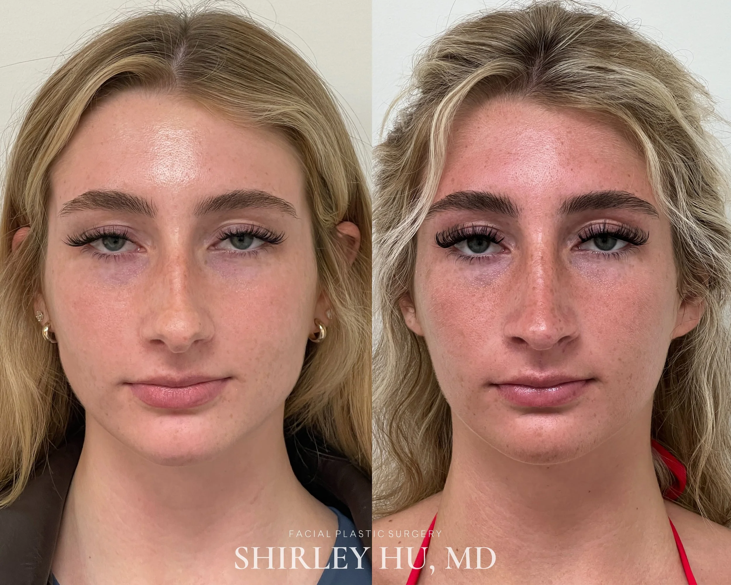 Primary rhinoplasty in a 22-year-old woman