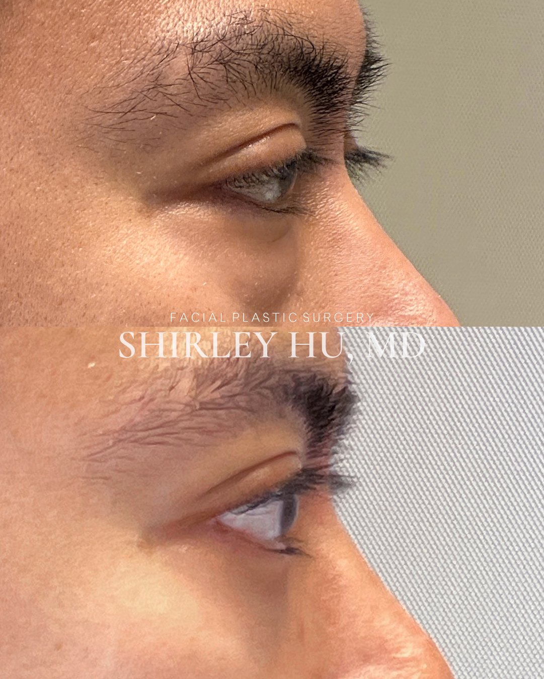 Lower blepharoplasty in a 38-year-old man