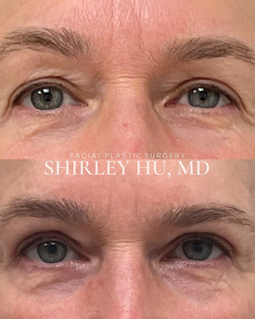 Upper blepharoplasty in a 64-year-old woman