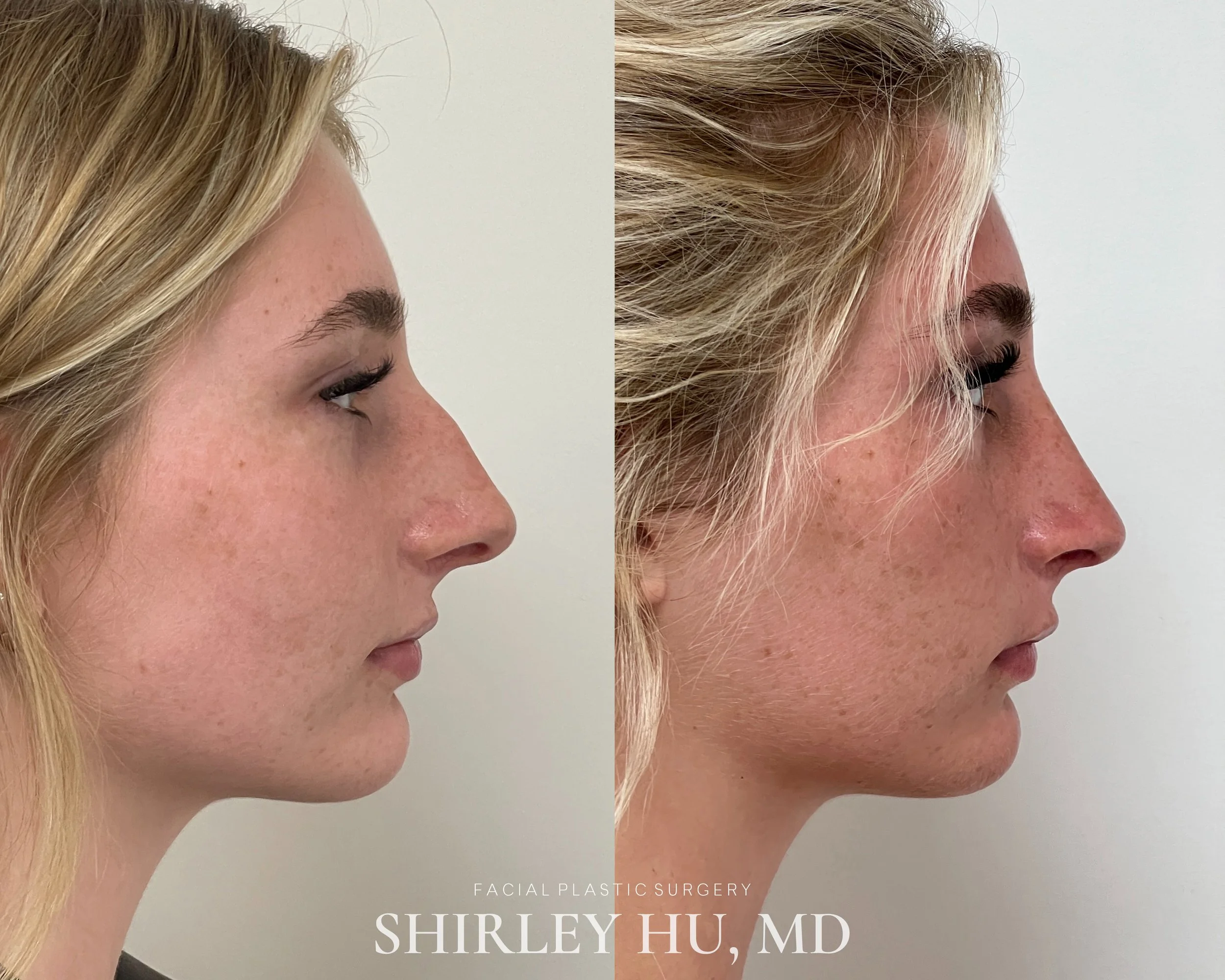 Primary rhinoplasty in a 22-year-old woman