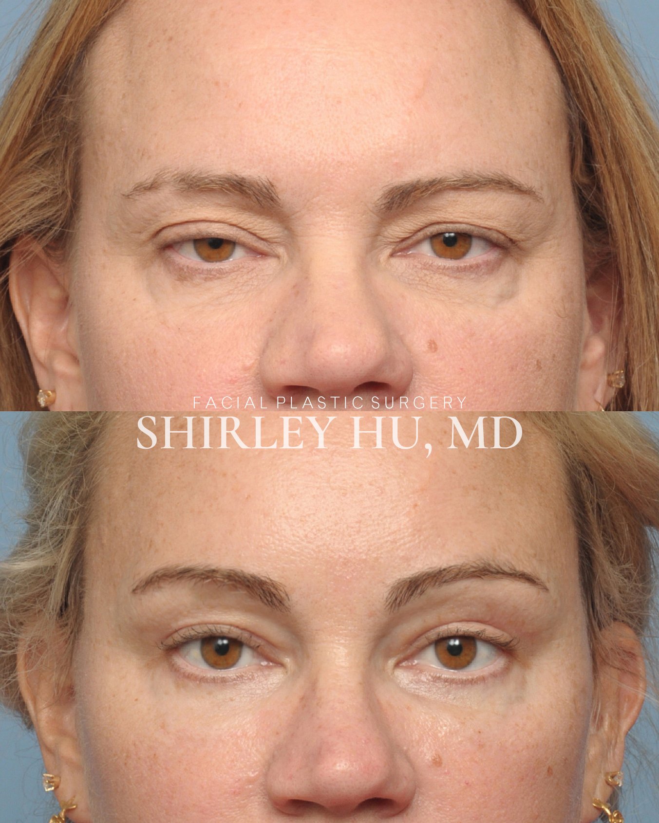 Endoscopic brow lift, upper blepharoplasty, and ptosis repair in a 53-year-old woman