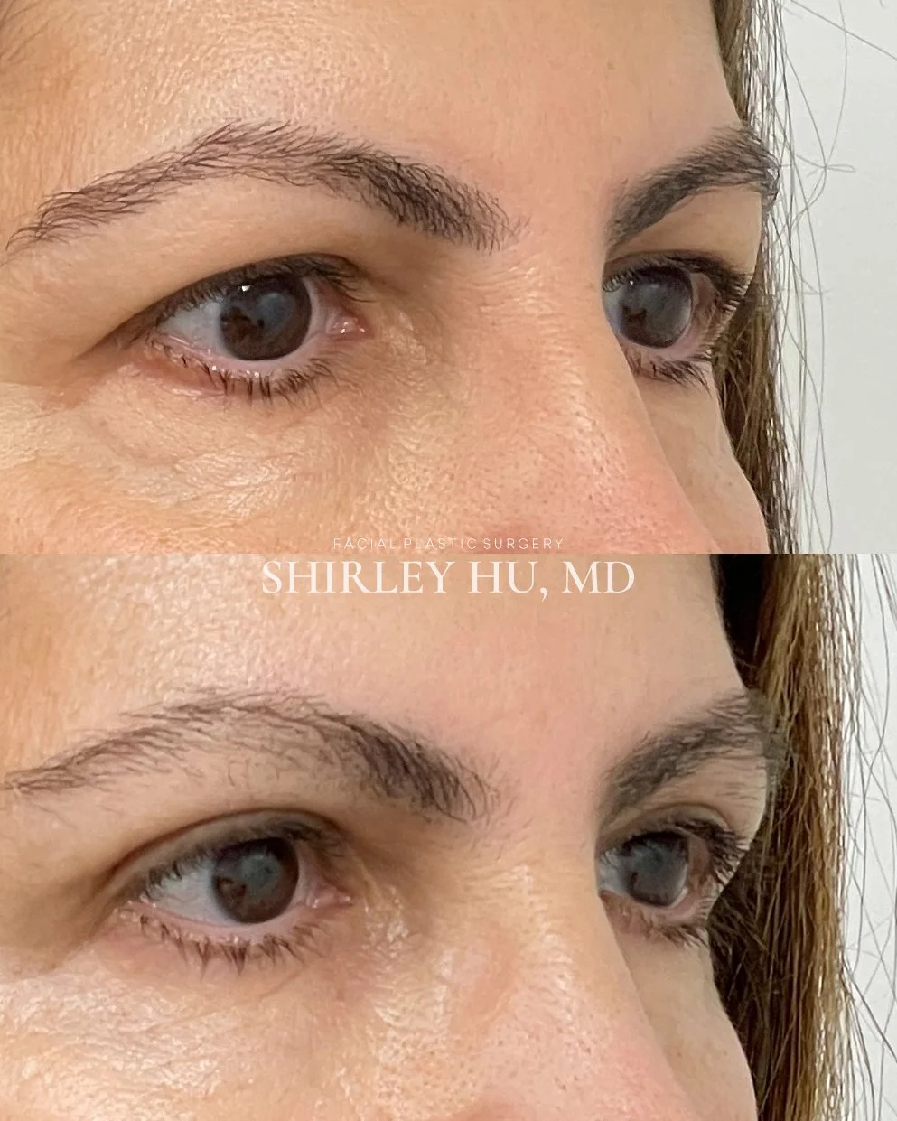 Upper and lower blepharoplasty in a 52-year-old woman