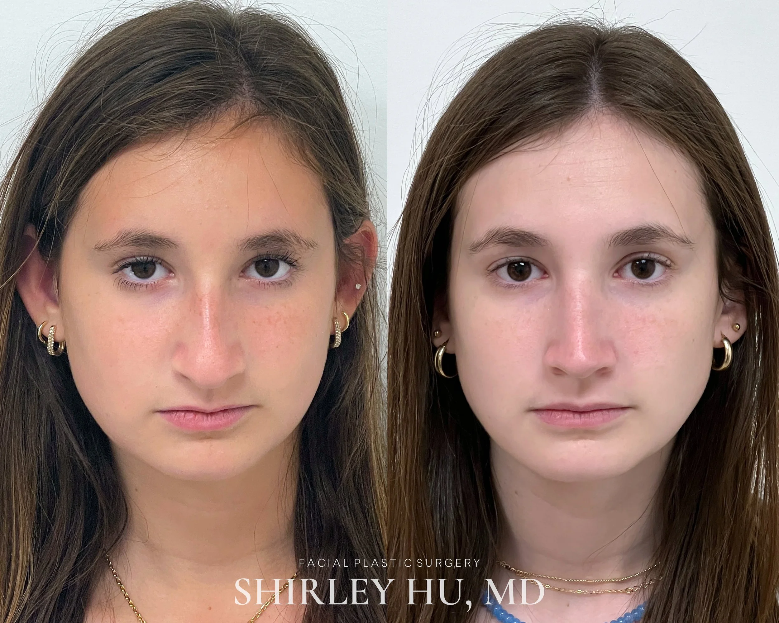 Primary rhinoplasty in a 15-year-old female