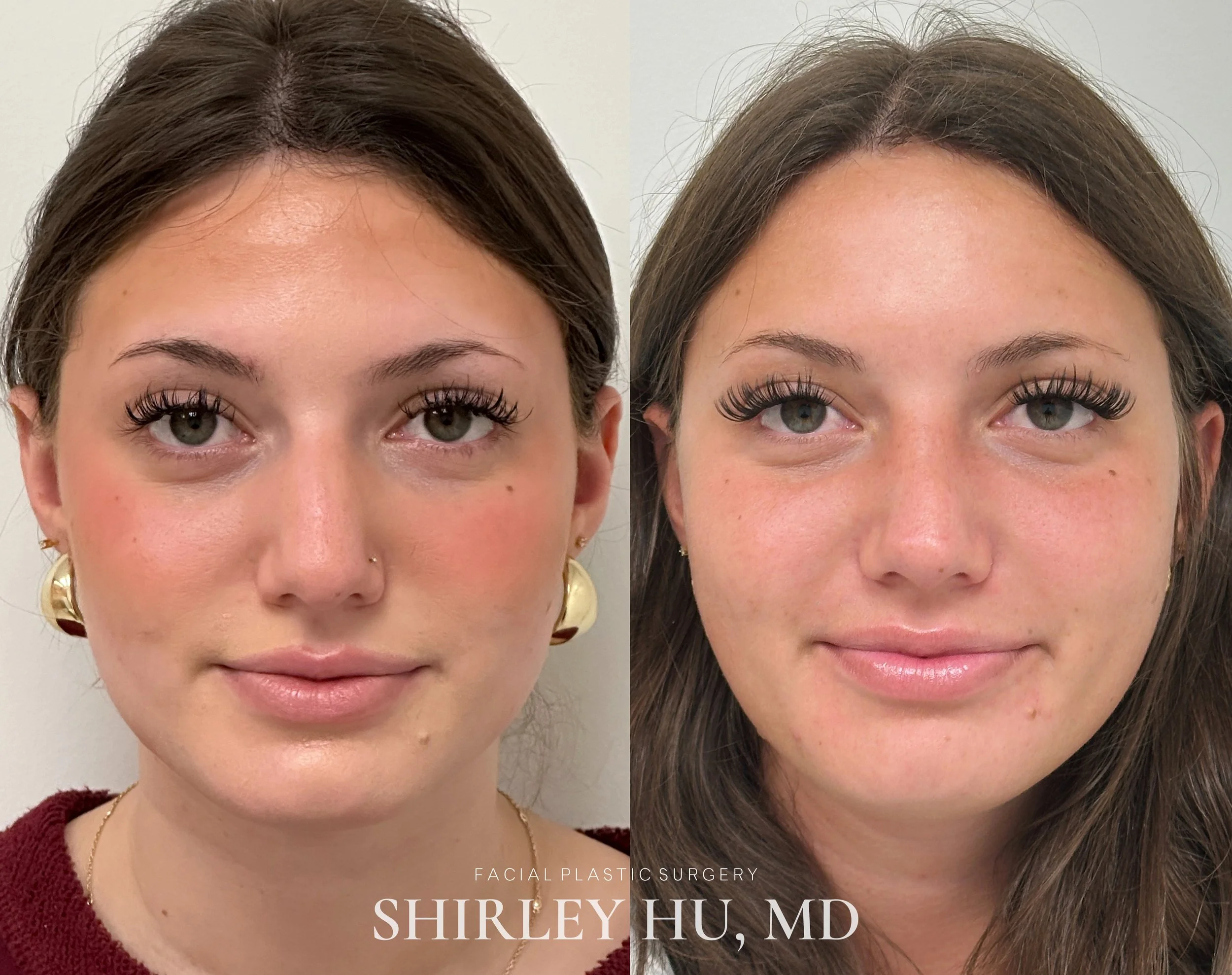 Primary rhinoplasty in a 20-year-old woman