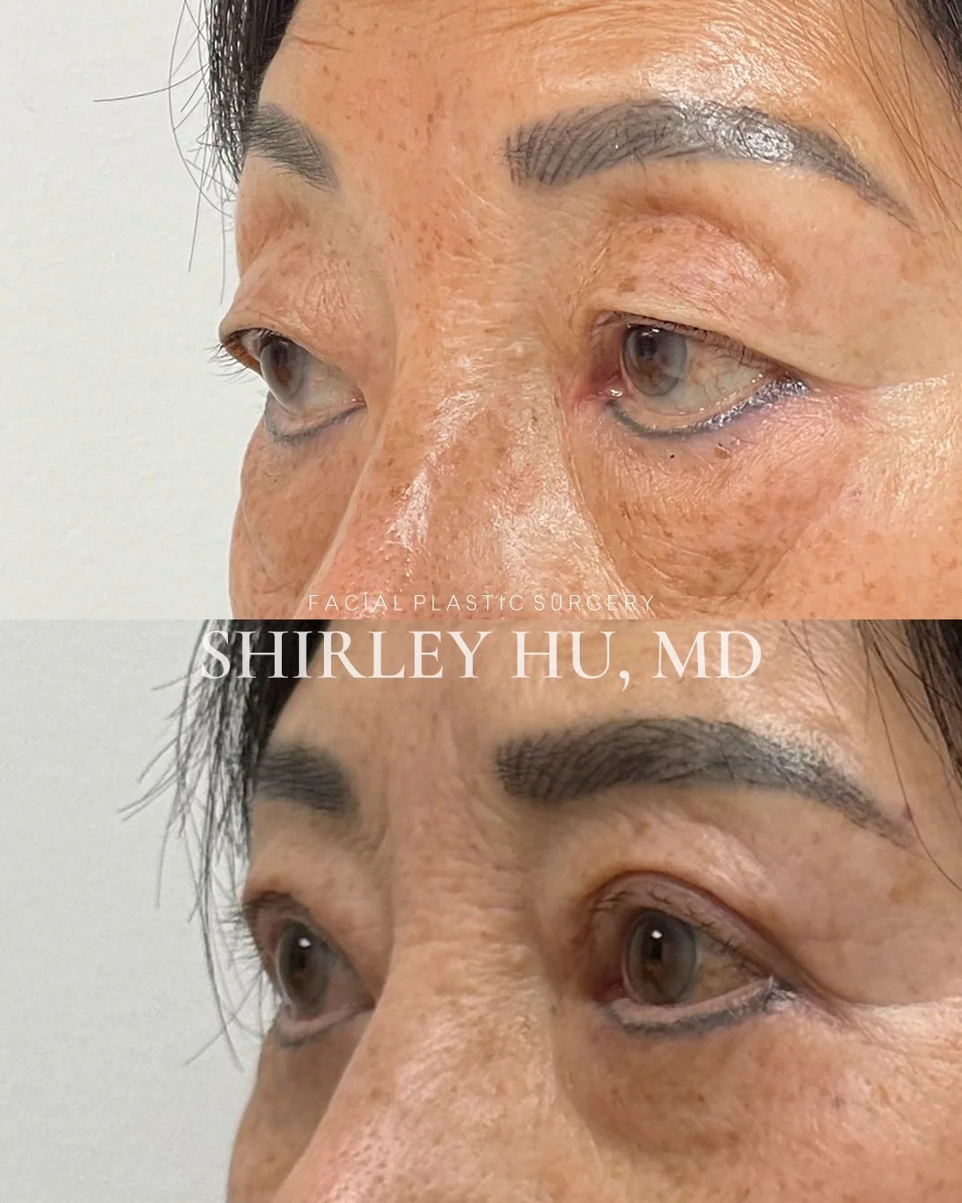 Upper blepharoplasty, ptosis repair, and lower blepharoplasty and in a 56-year-old woman