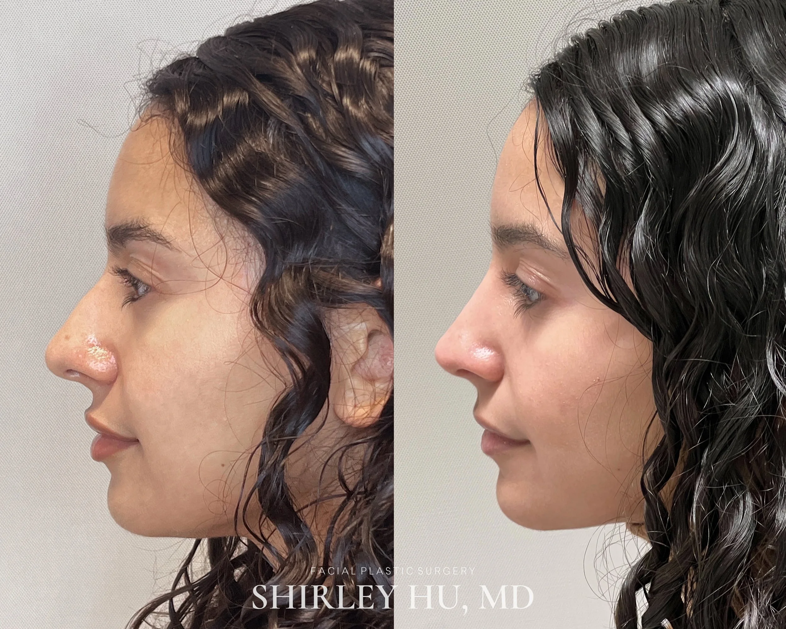 Primary rhinoplasty in a 30-year-old woman