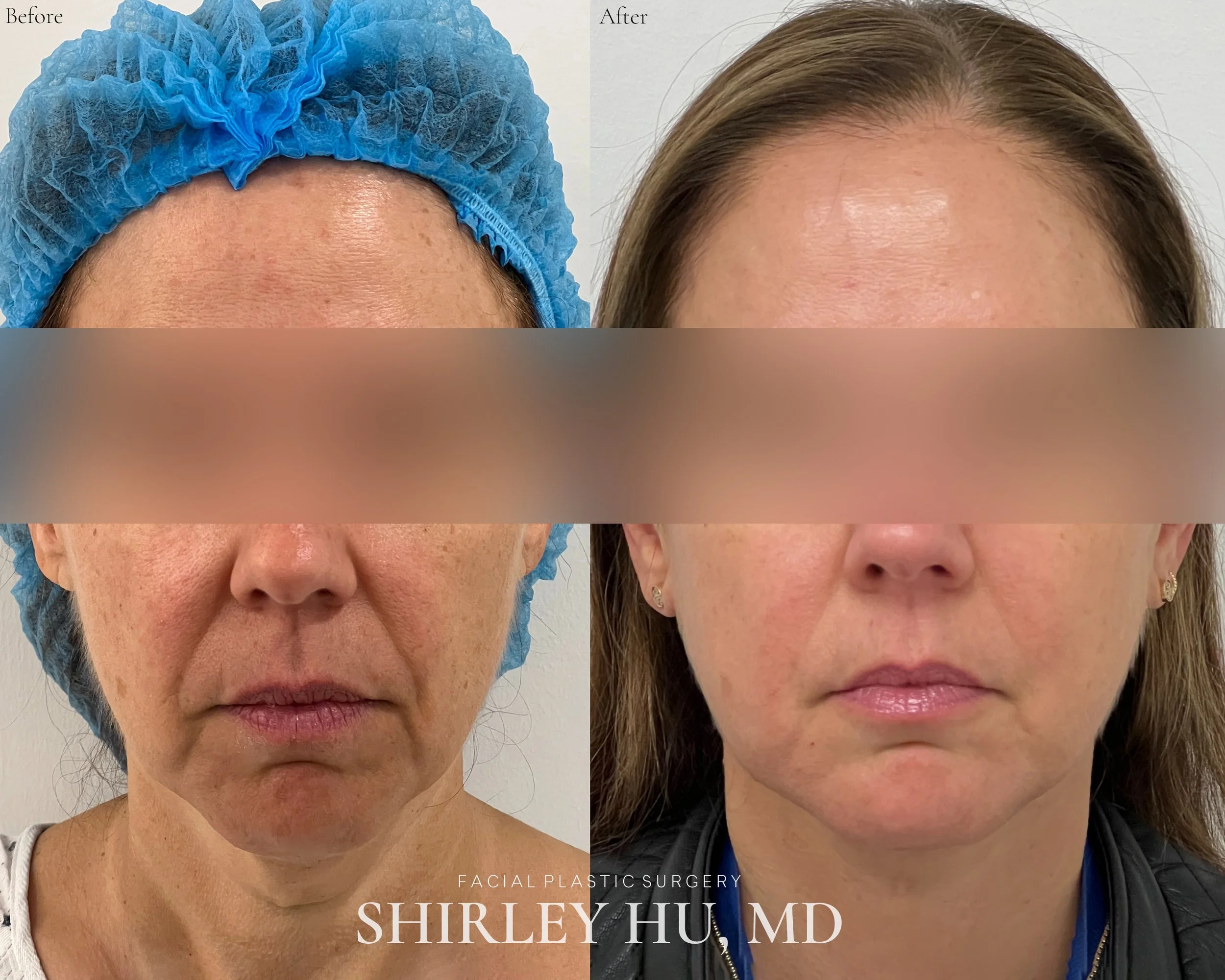 Extended neck lift in a 46-year-old woman 