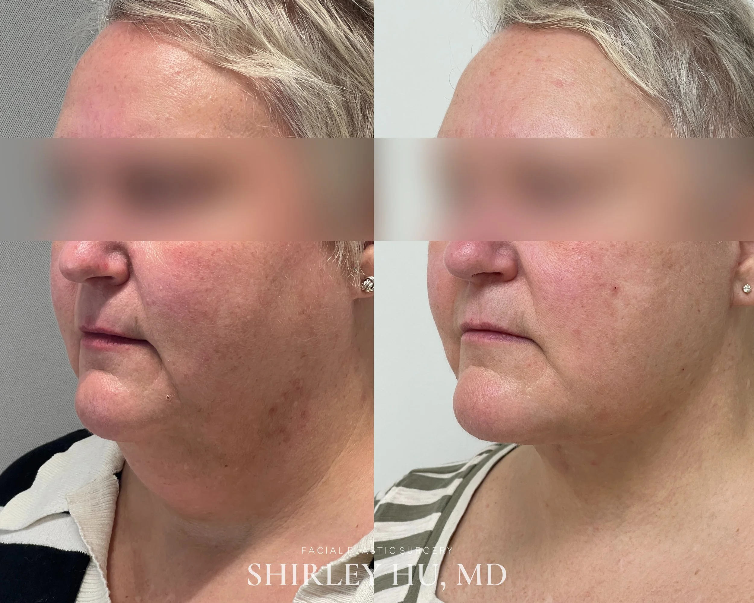 Extended deep plane face and neck lift in a 55-year-old woman
